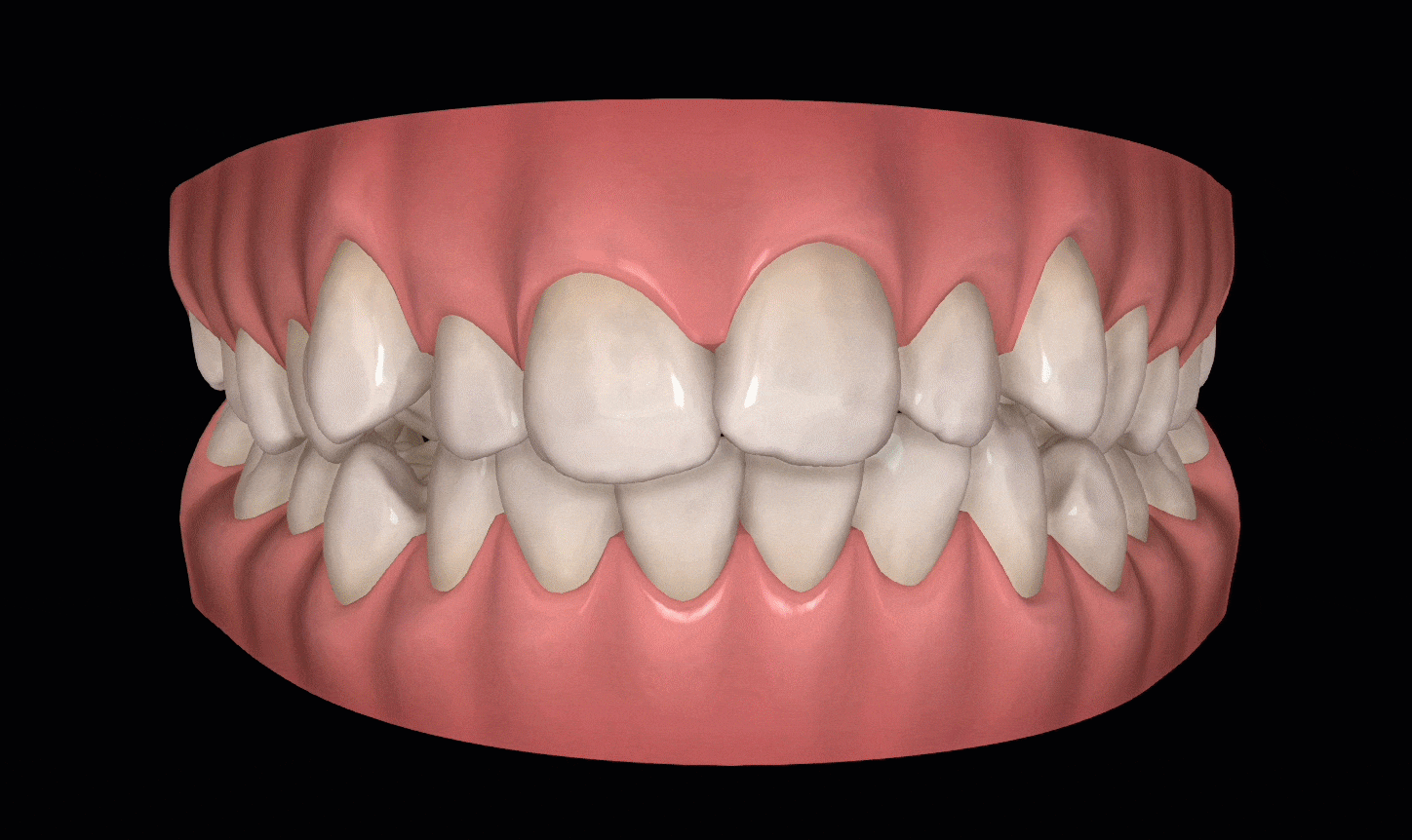 Teeth movement during Invisalign treatment moving image