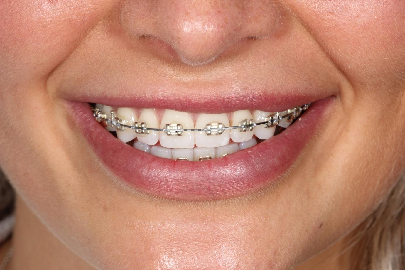 Fixed braces patient smiling with rose gold brackets fitted
