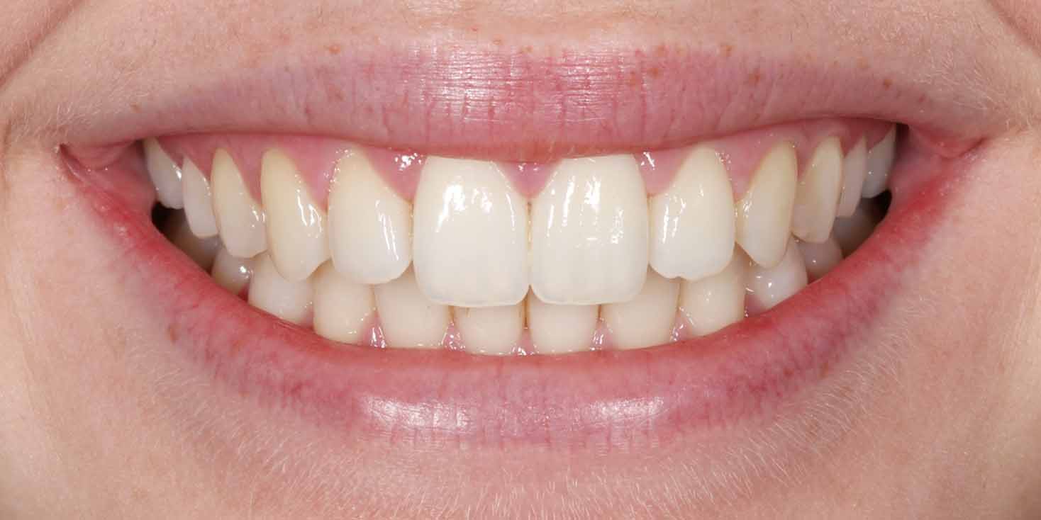 Child patient smiling after Invisalign treatment