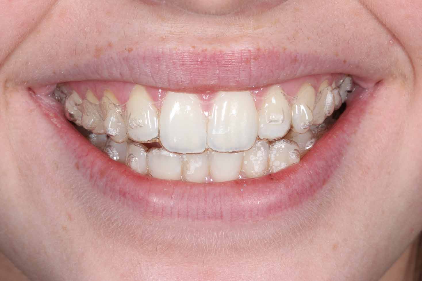 Child patient smiling with Invisalign clear aligners fitted