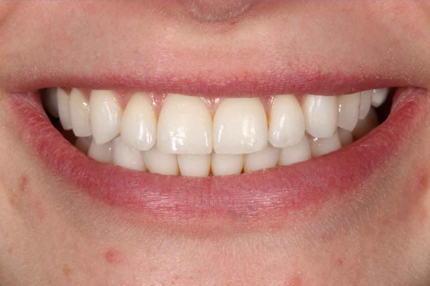 Fixed braces with rose gold brackets patient smiling after treatment