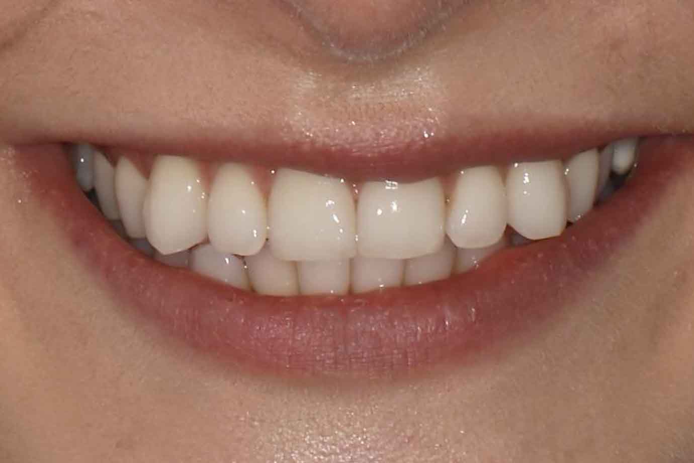 Fixed braces with rose gold brackets patient smiling before treatment