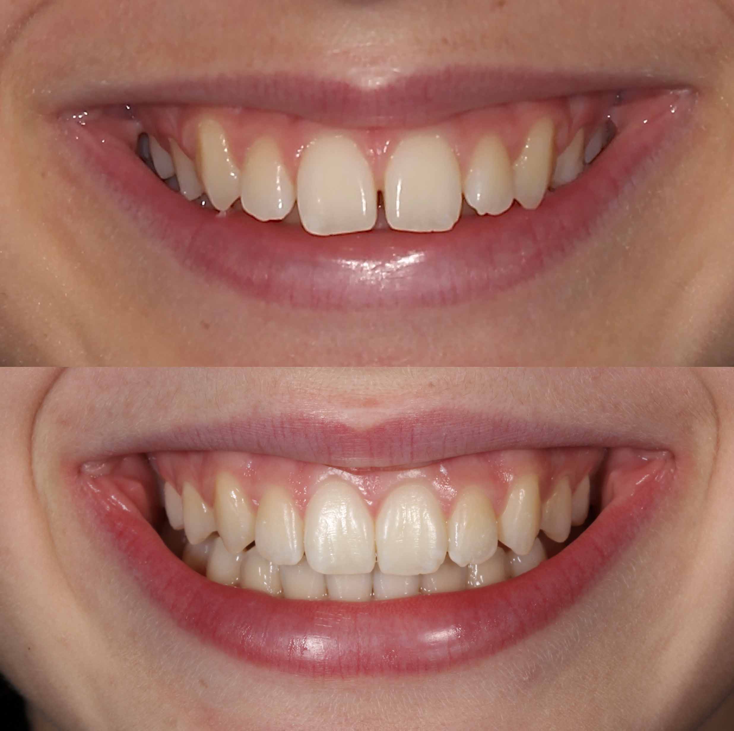 before and after photo of Invisalign treatment for children