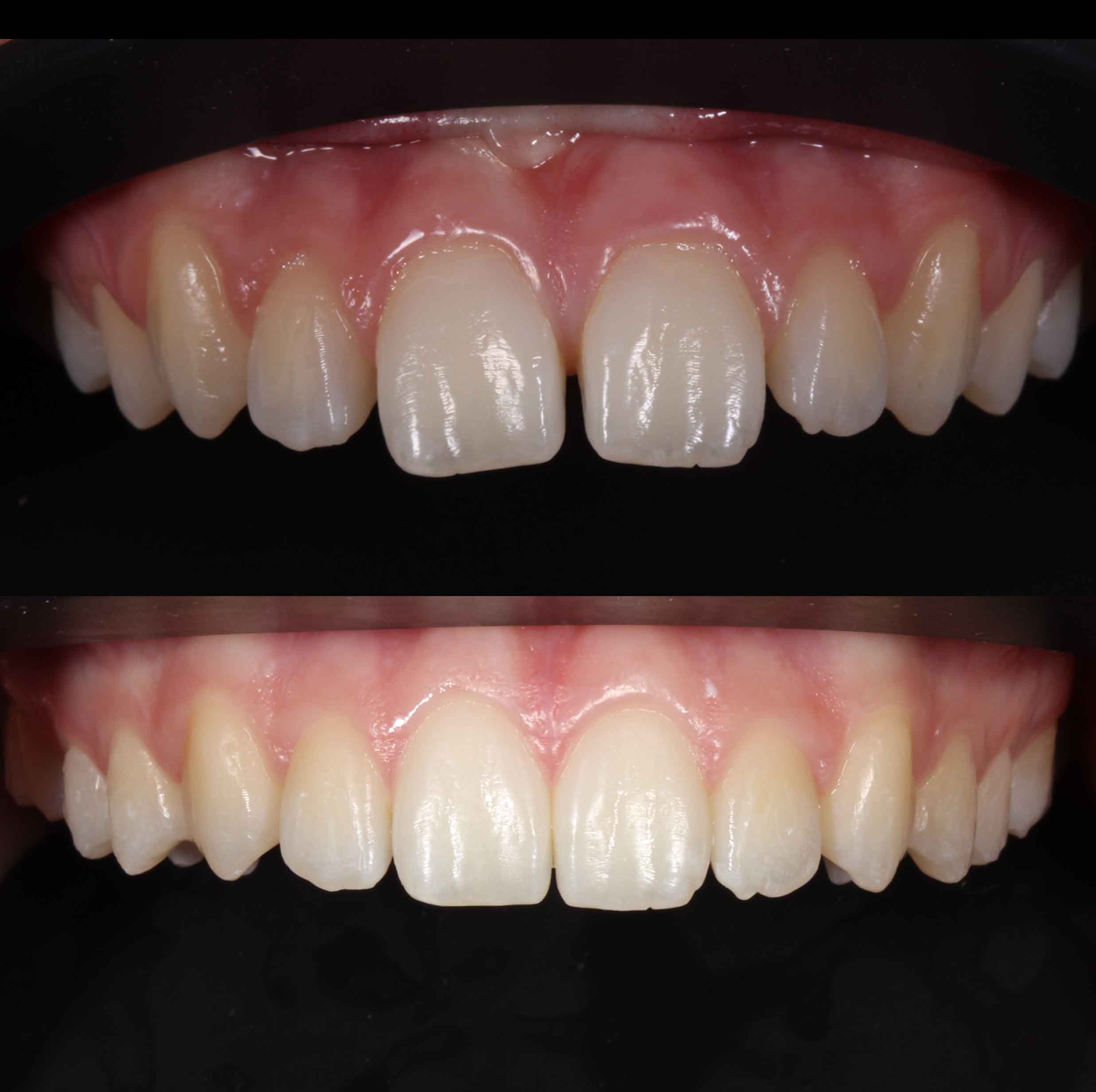 before and after photo of Invisalign treatment for children