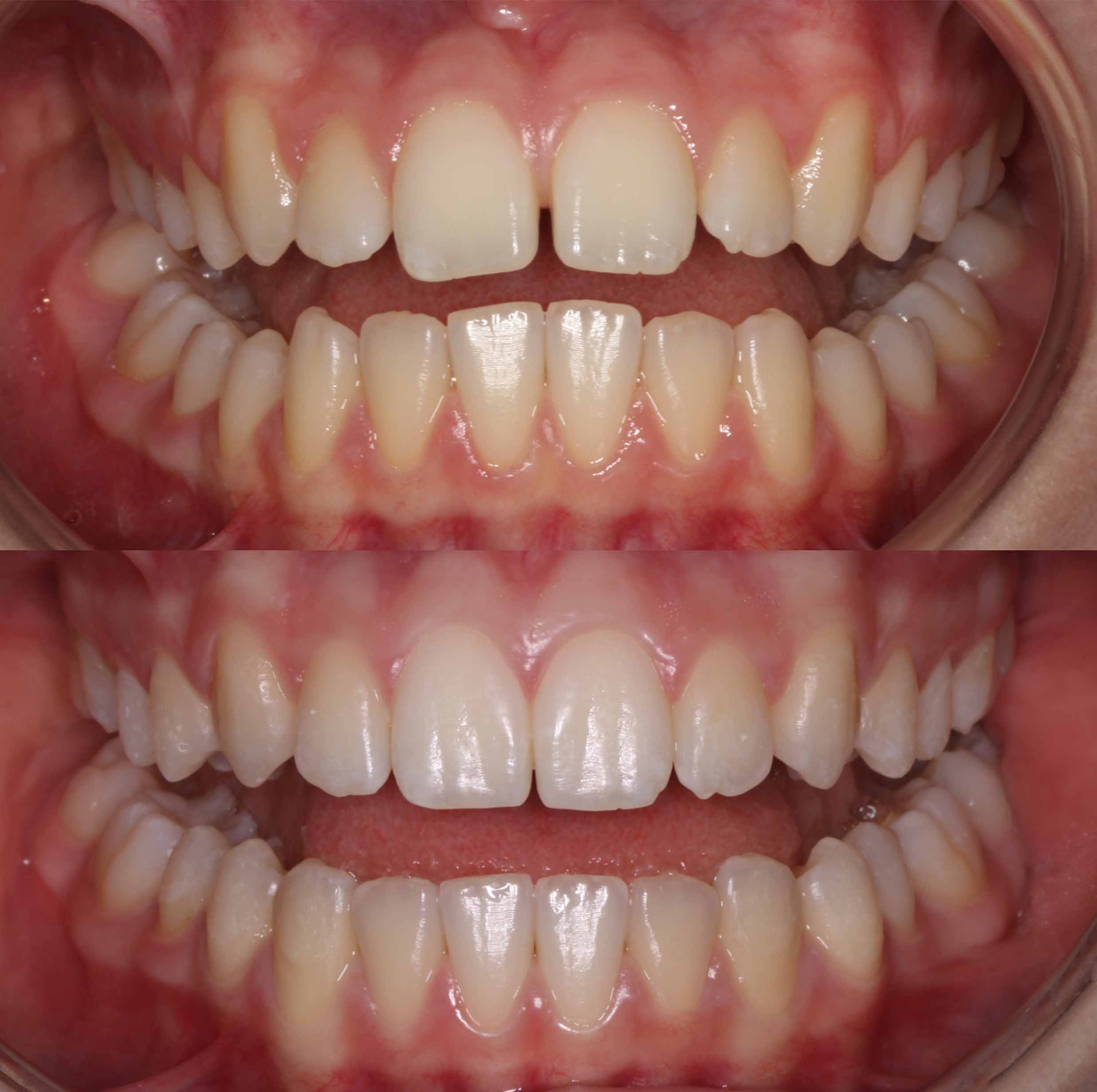 before and after photo of Invisalign treatment for children