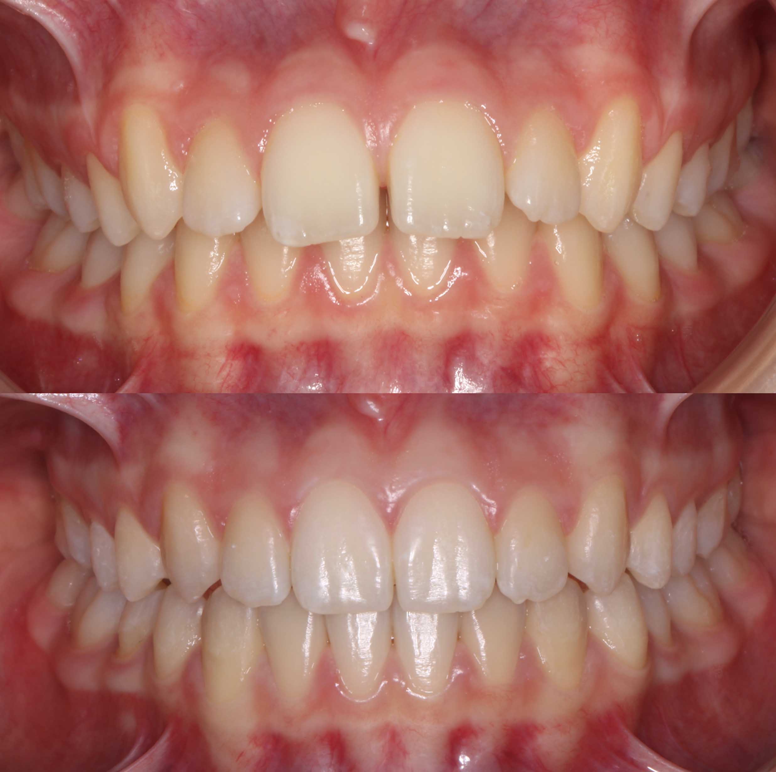 before and after photo of Invisalign treatment for children