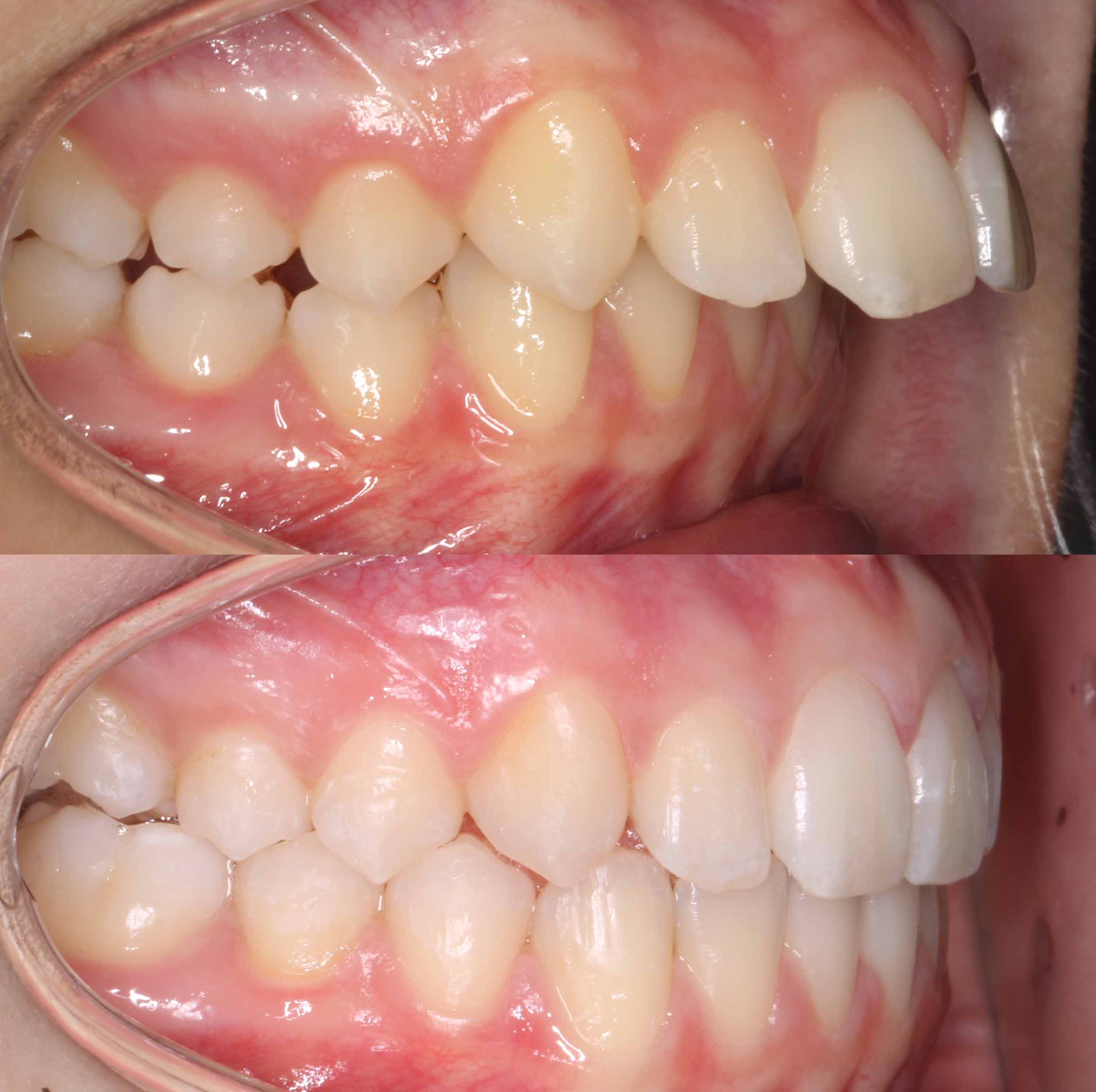 before and after photo of Invisalign treatment for children