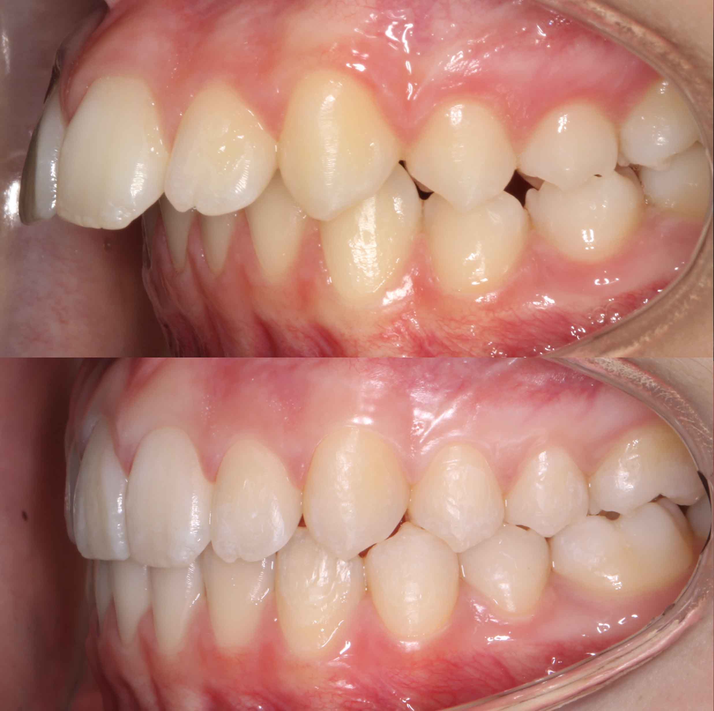 before and after photo of Invisalign treatment for children