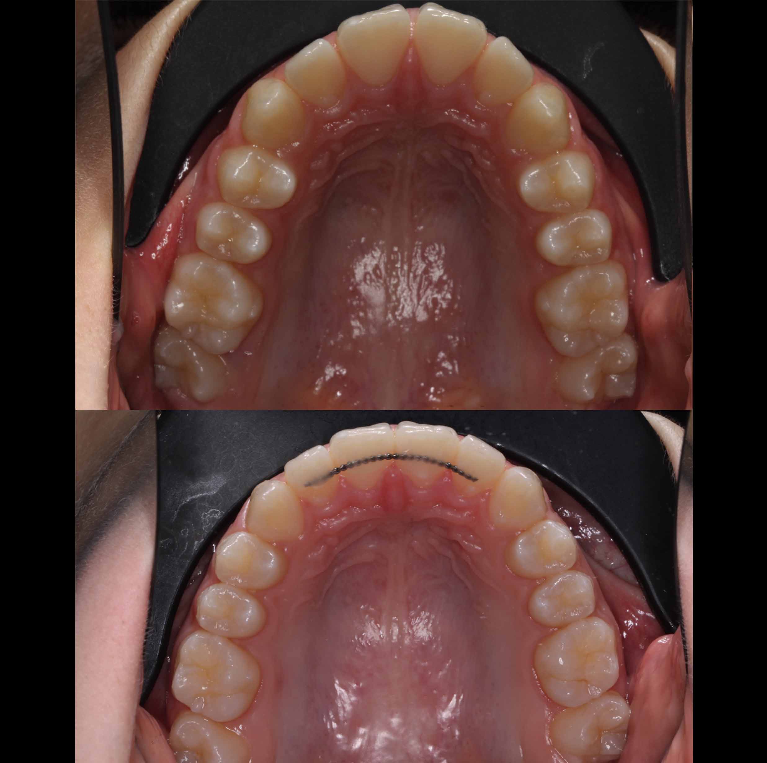 before and after photo of Invisalign treatment for children