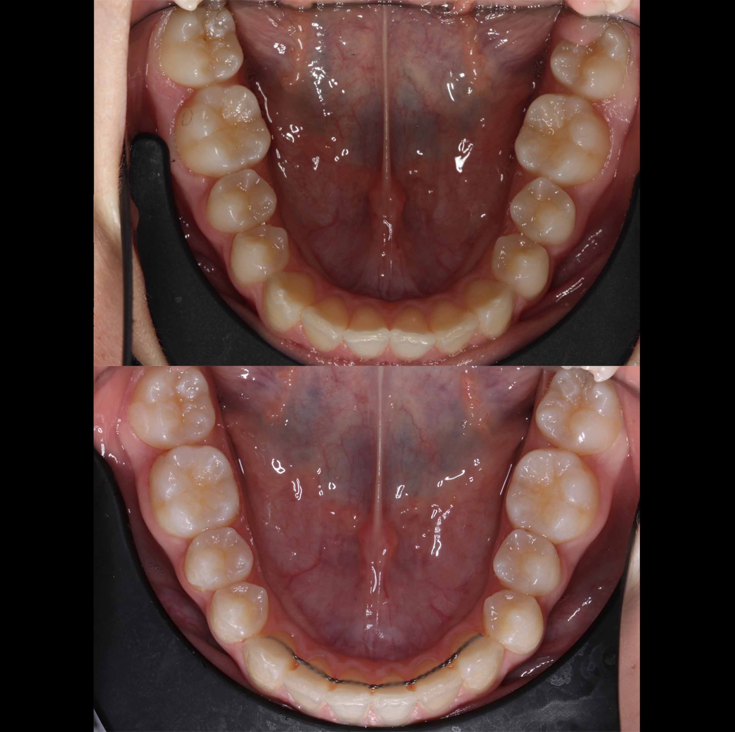 before and after photo of Invisalign treatment for children