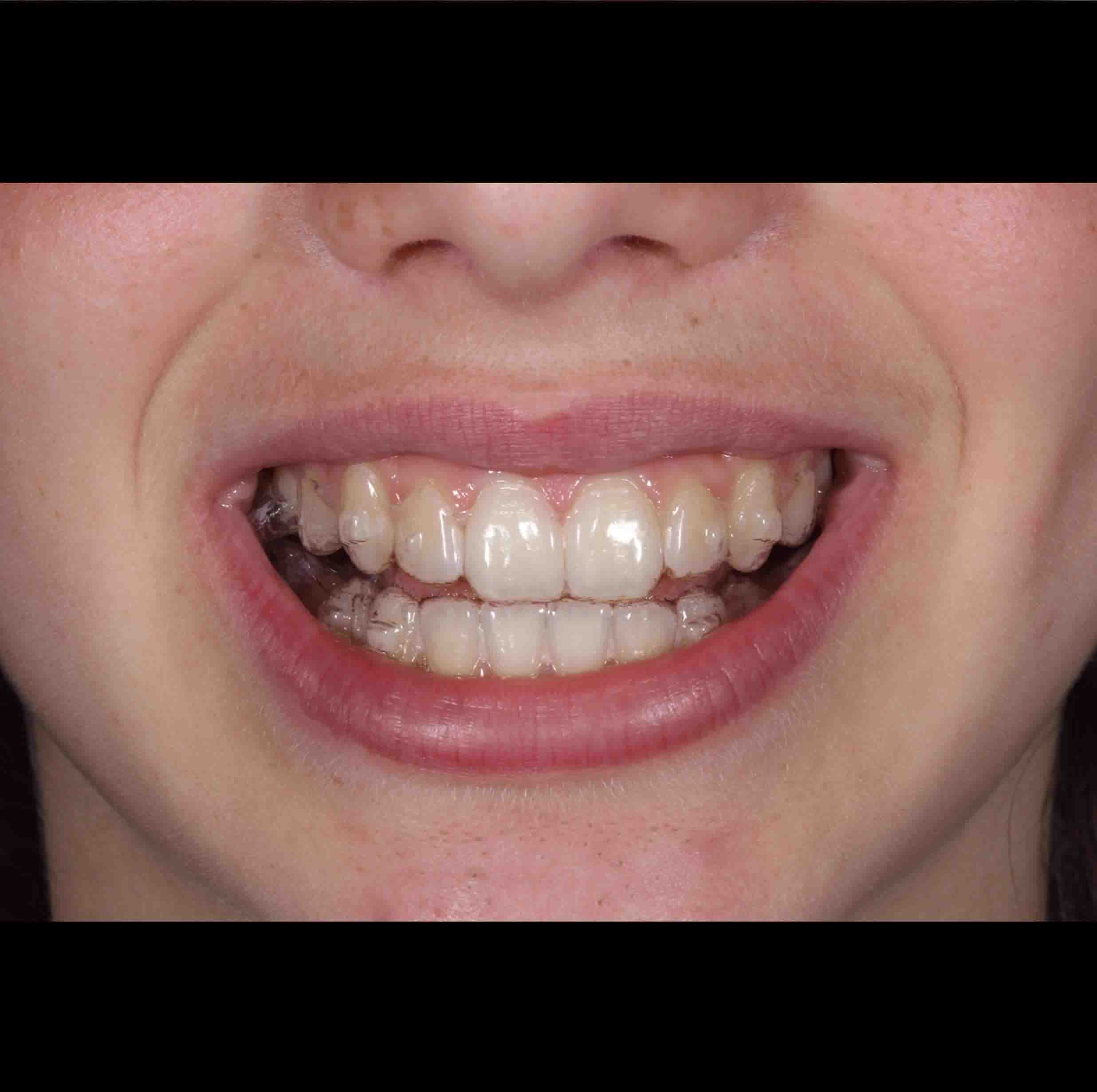 before and after photo of Invisalign treatment for children
