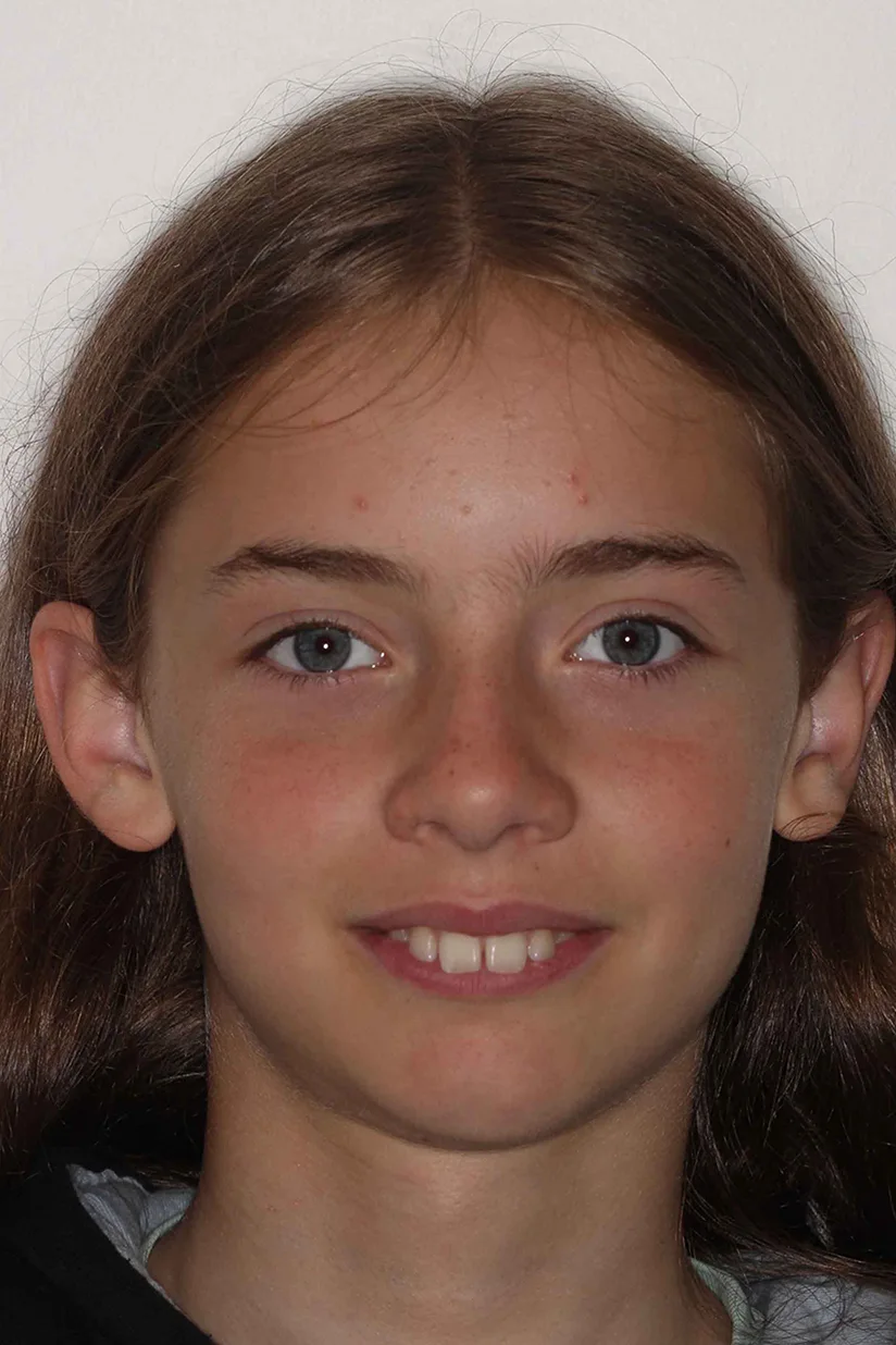 before and after photo of Invisalign treatment for children