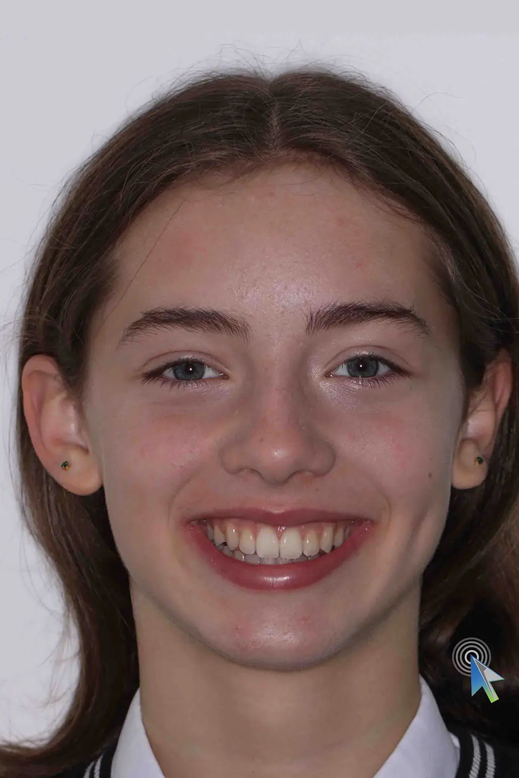 before and after photo of Invisalign treatment for children