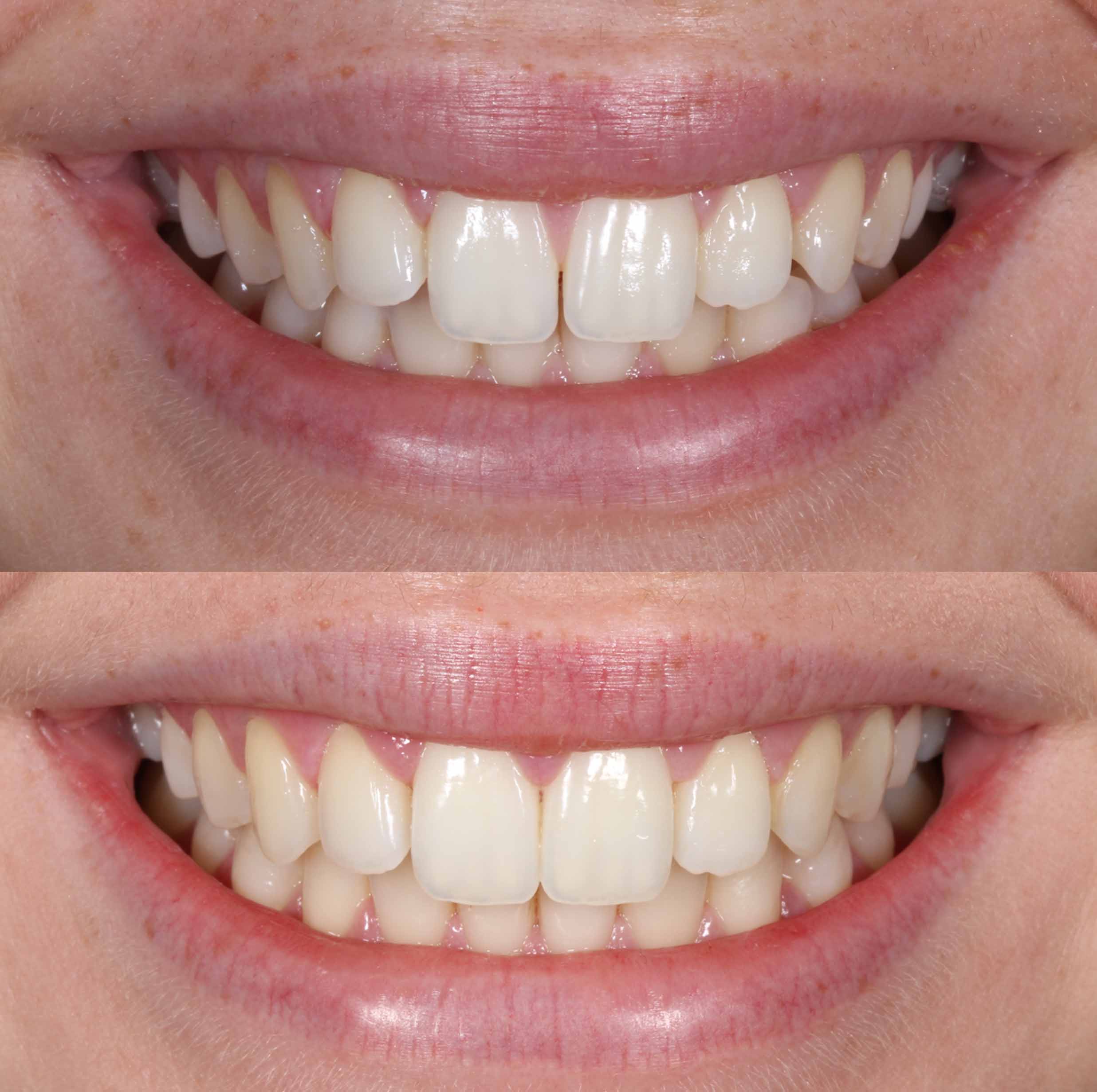 before and after photo of Invisalign treatment for children