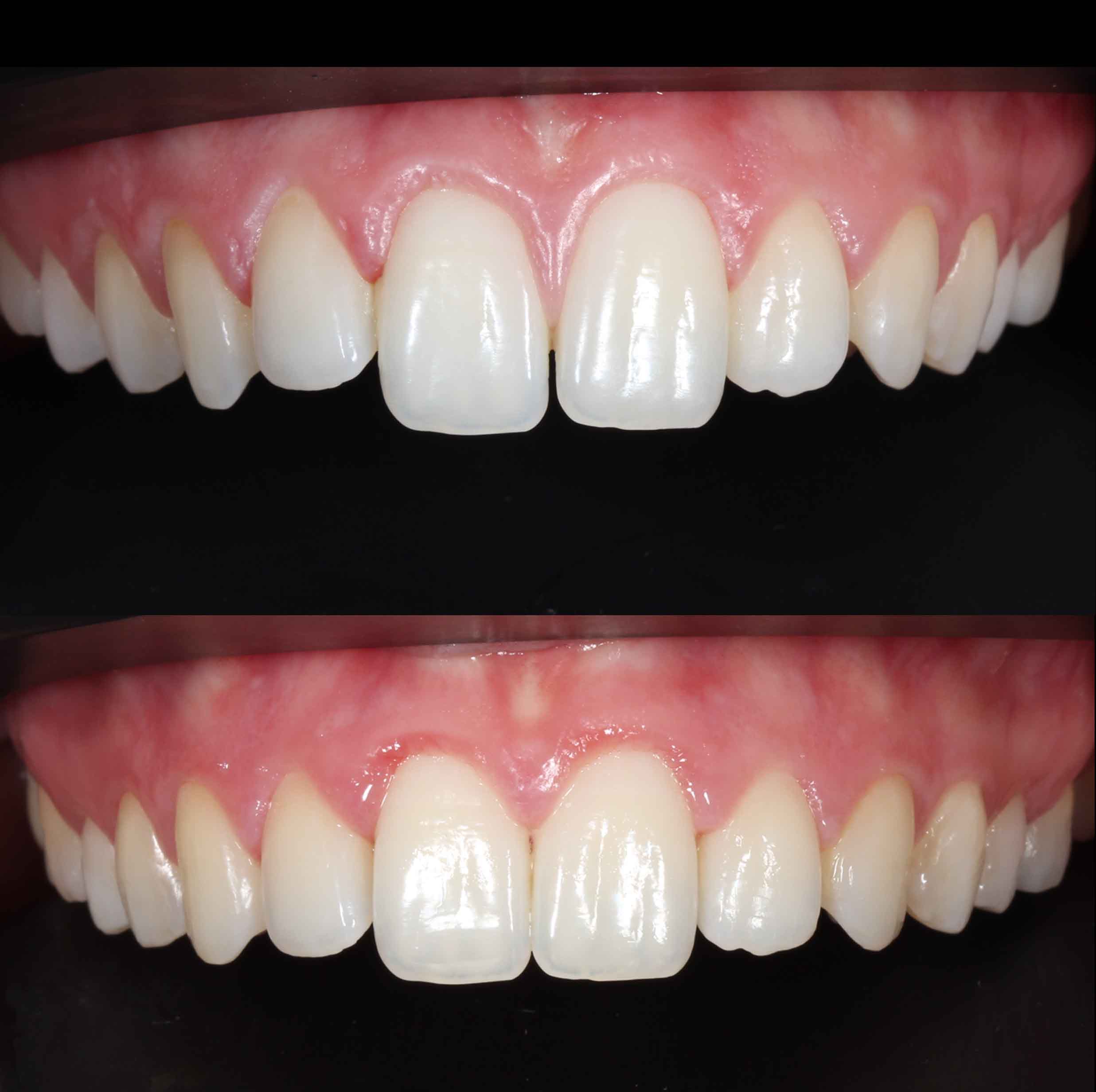 before and after photo of Invisalign treatment for children