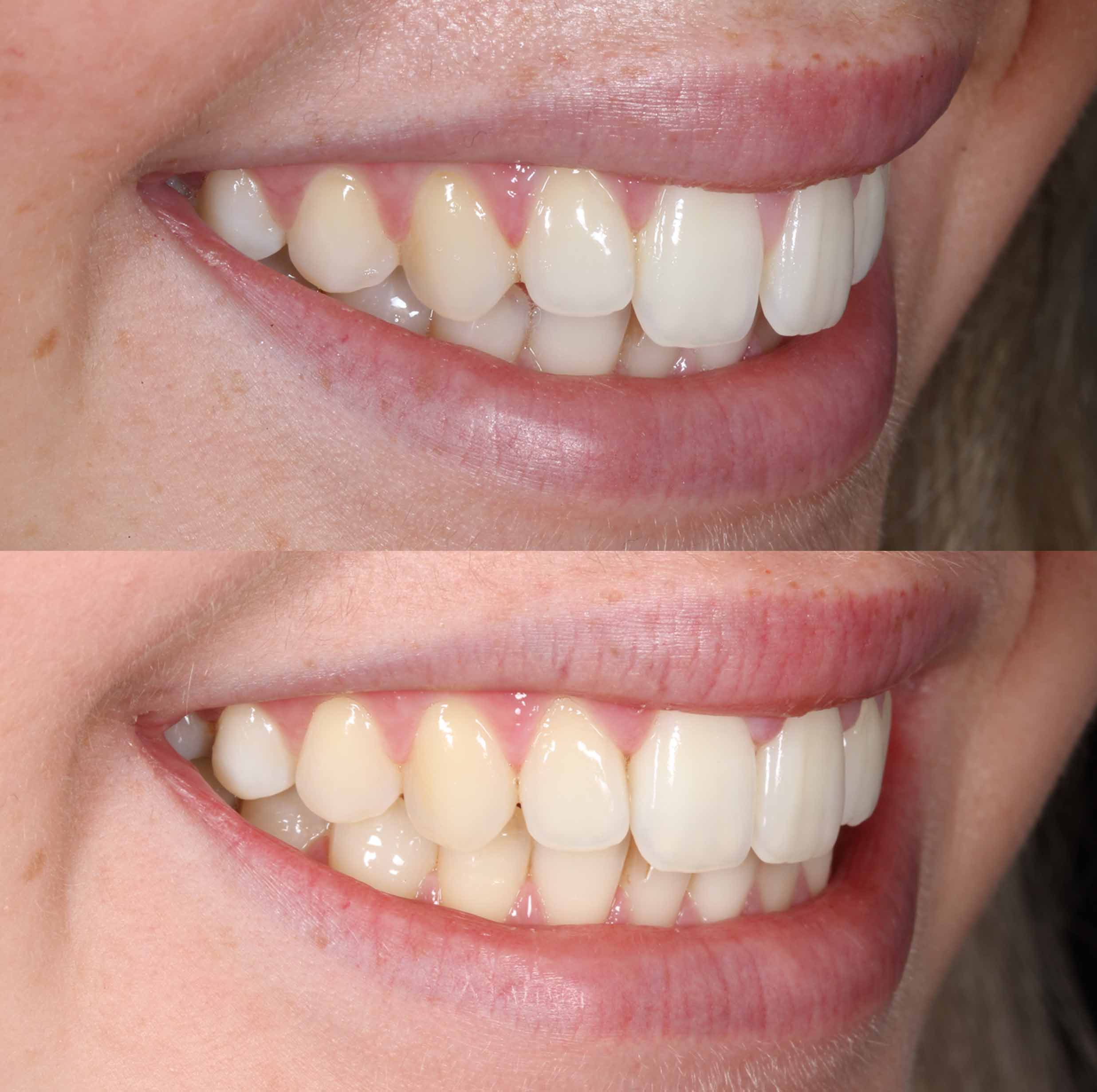 before and after photo of Invisalign treatment for children