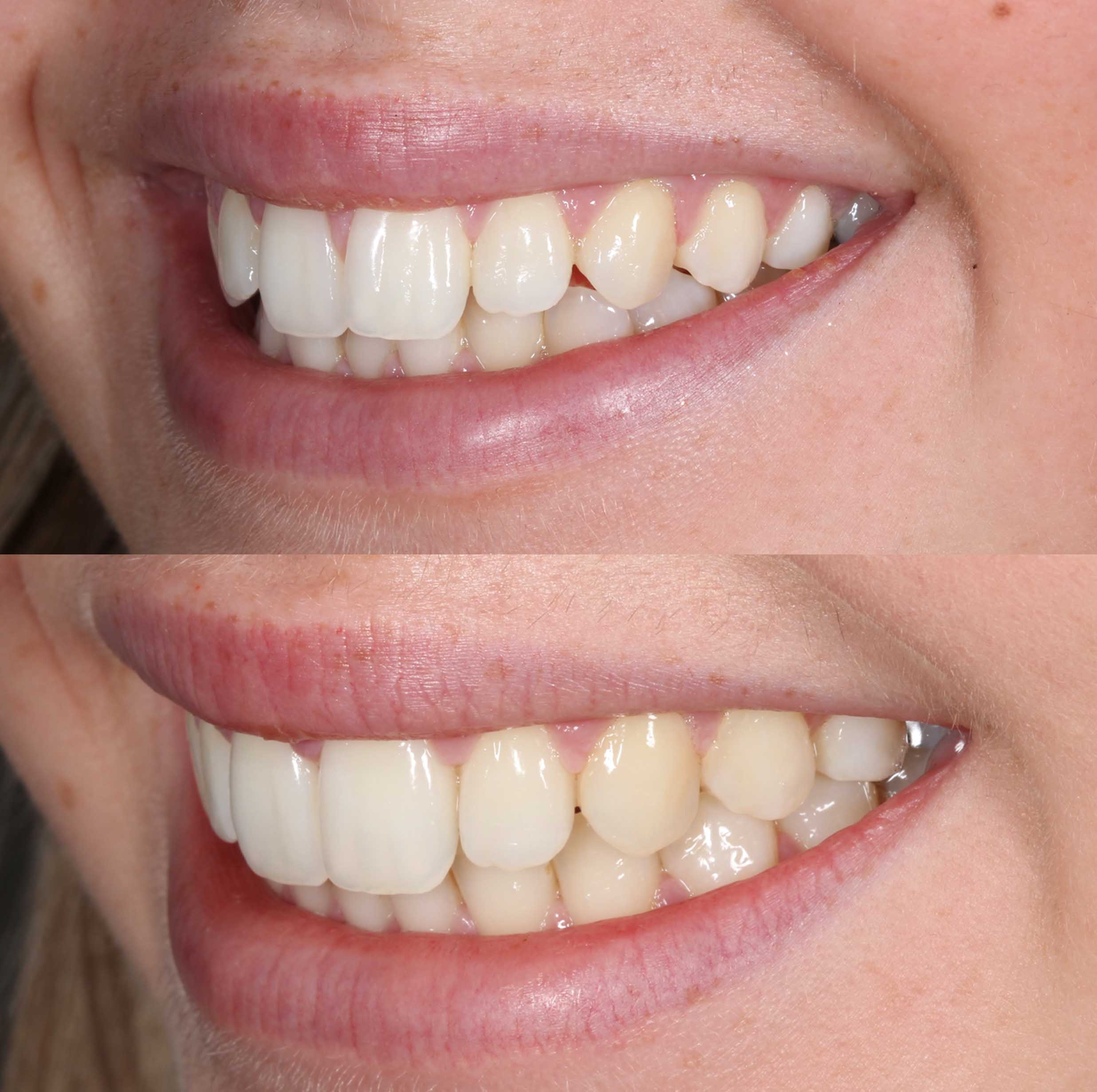 before and after photo of Invisalign treatment for children