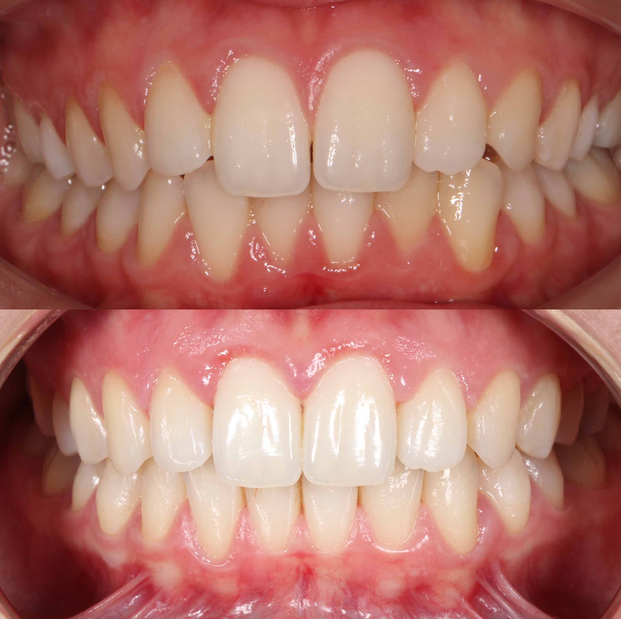 before and after photo of Invisalign treatment for children