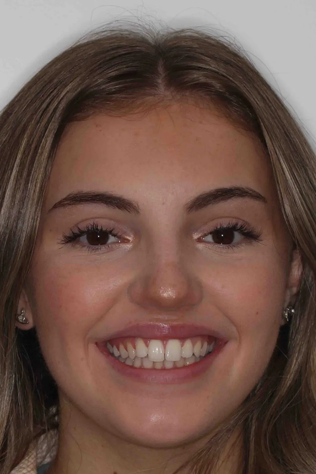 before and after photo of Invisalign treatment for children