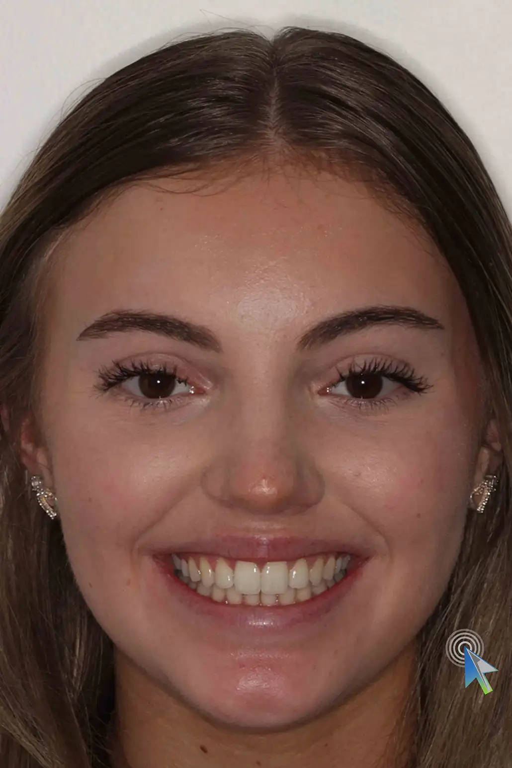 before and after photo of Invisalign treatment for children