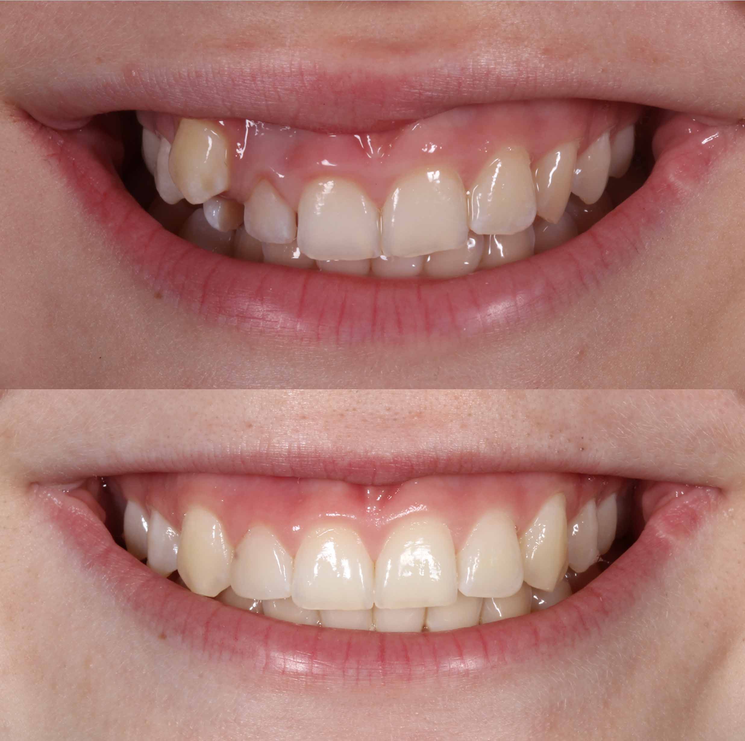 before and after photo of traditional metal fixed braces treatment for adults