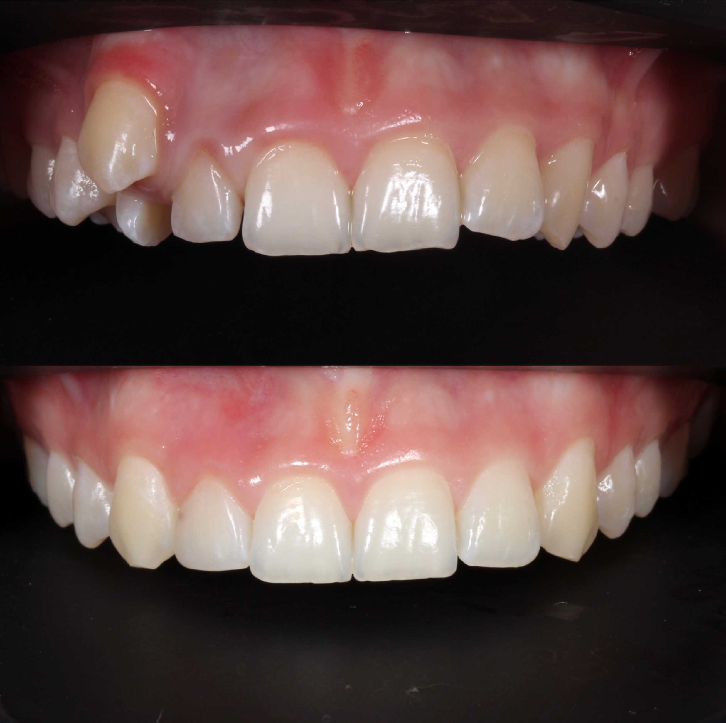 before and after photo of traditional metal fixed braces treatment for adults