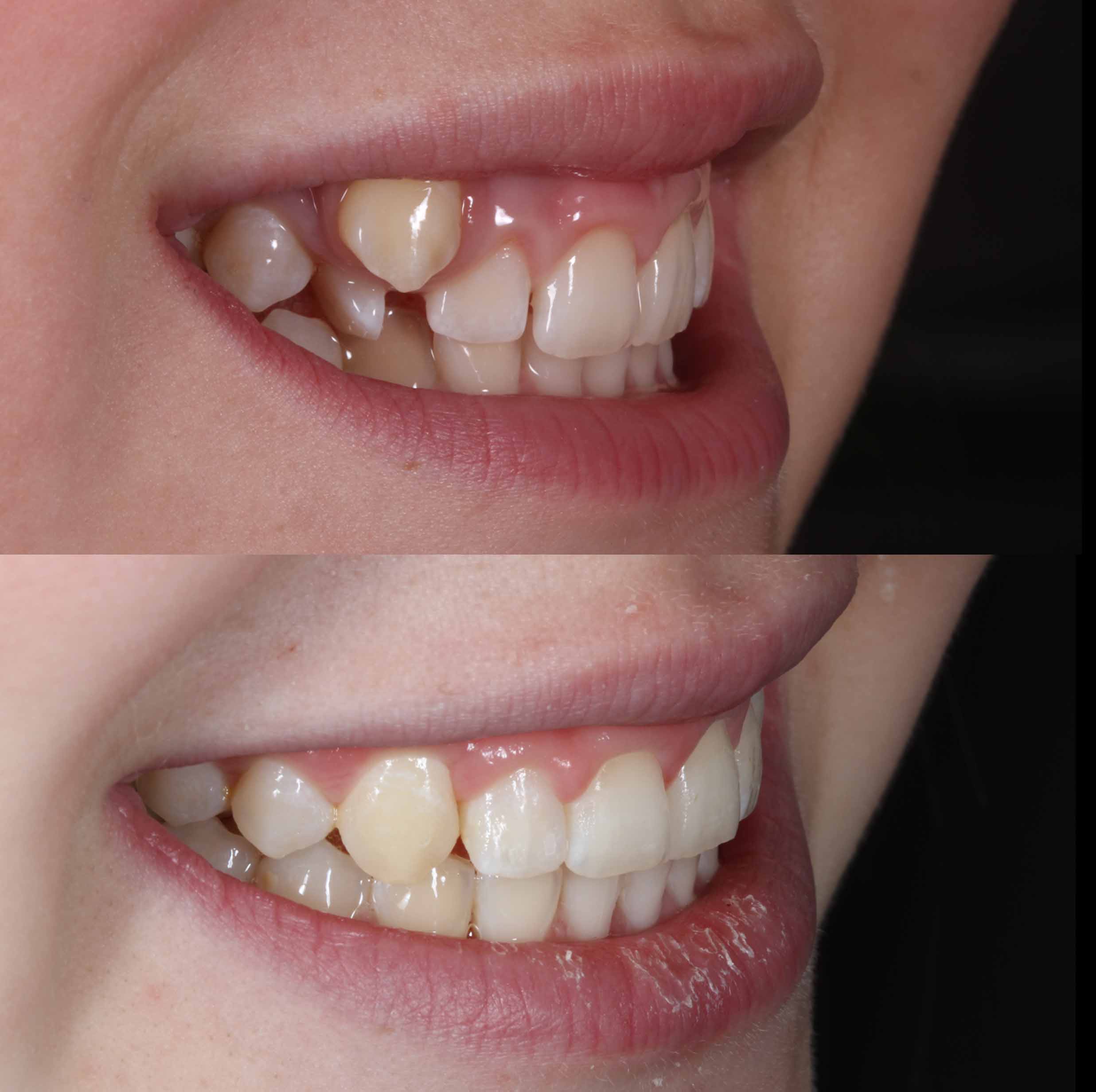 before and after photo of traditional metal fixed braces treatment for adults
