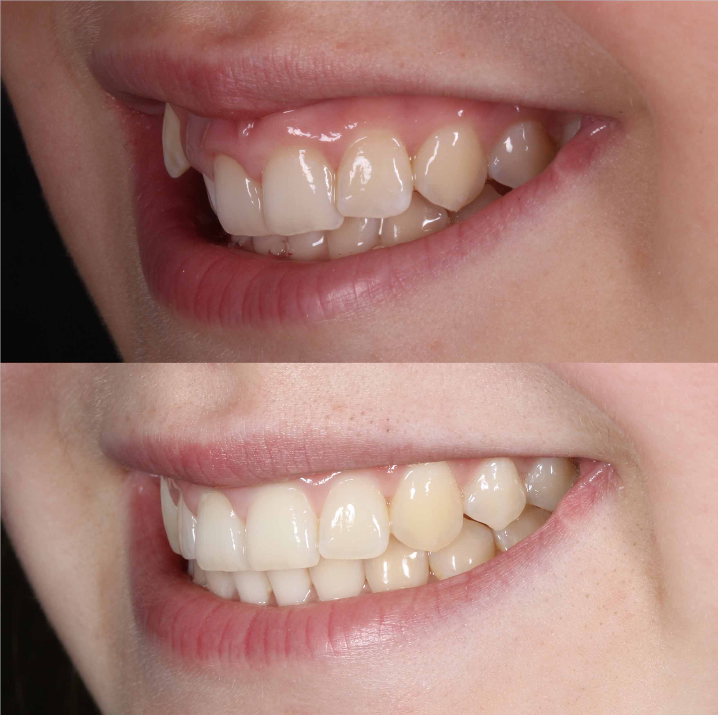 before and after photo of traditional metal fixed braces treatment for adults