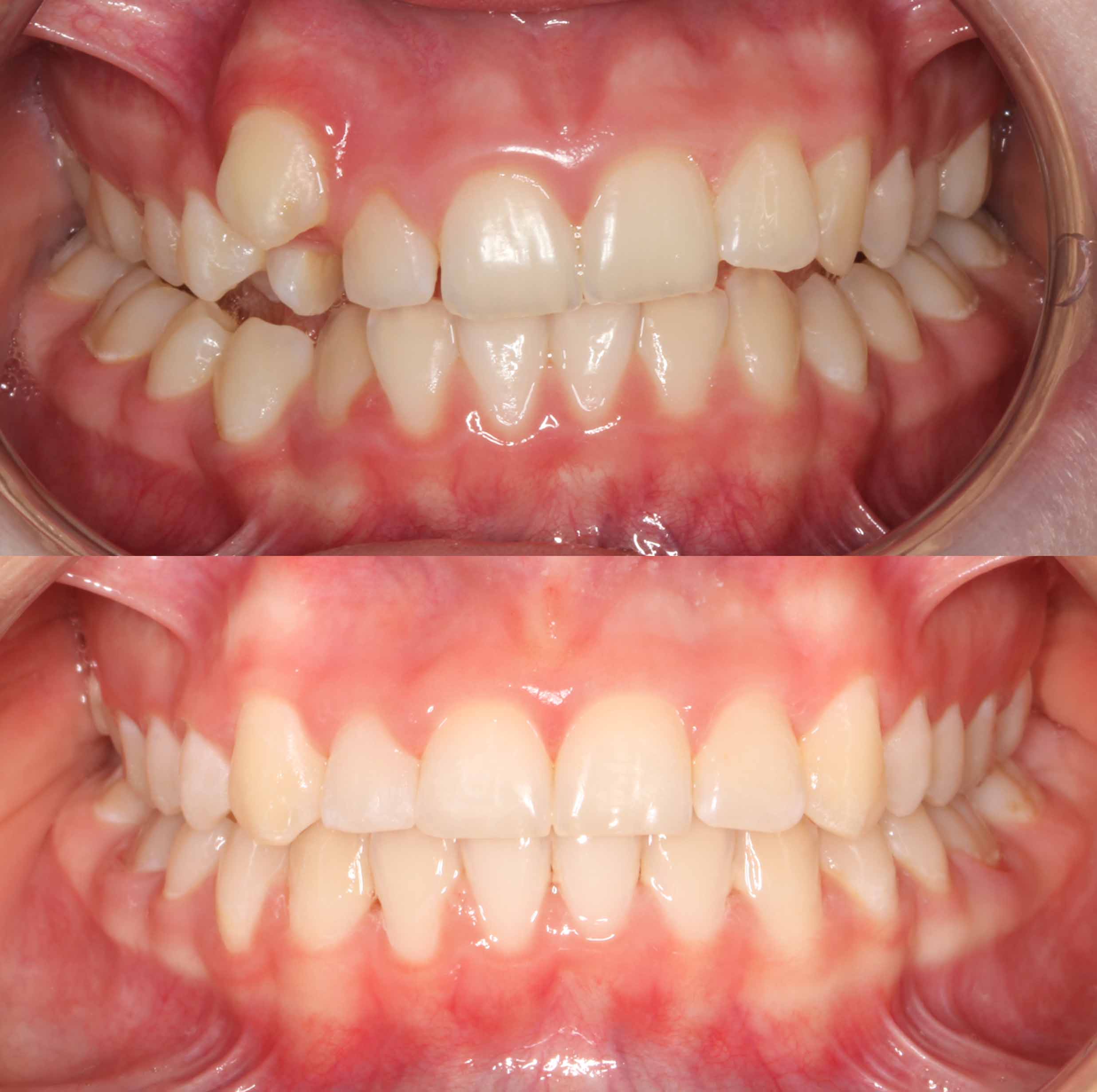 before and after photo of traditional metal fixed braces treatment for adults