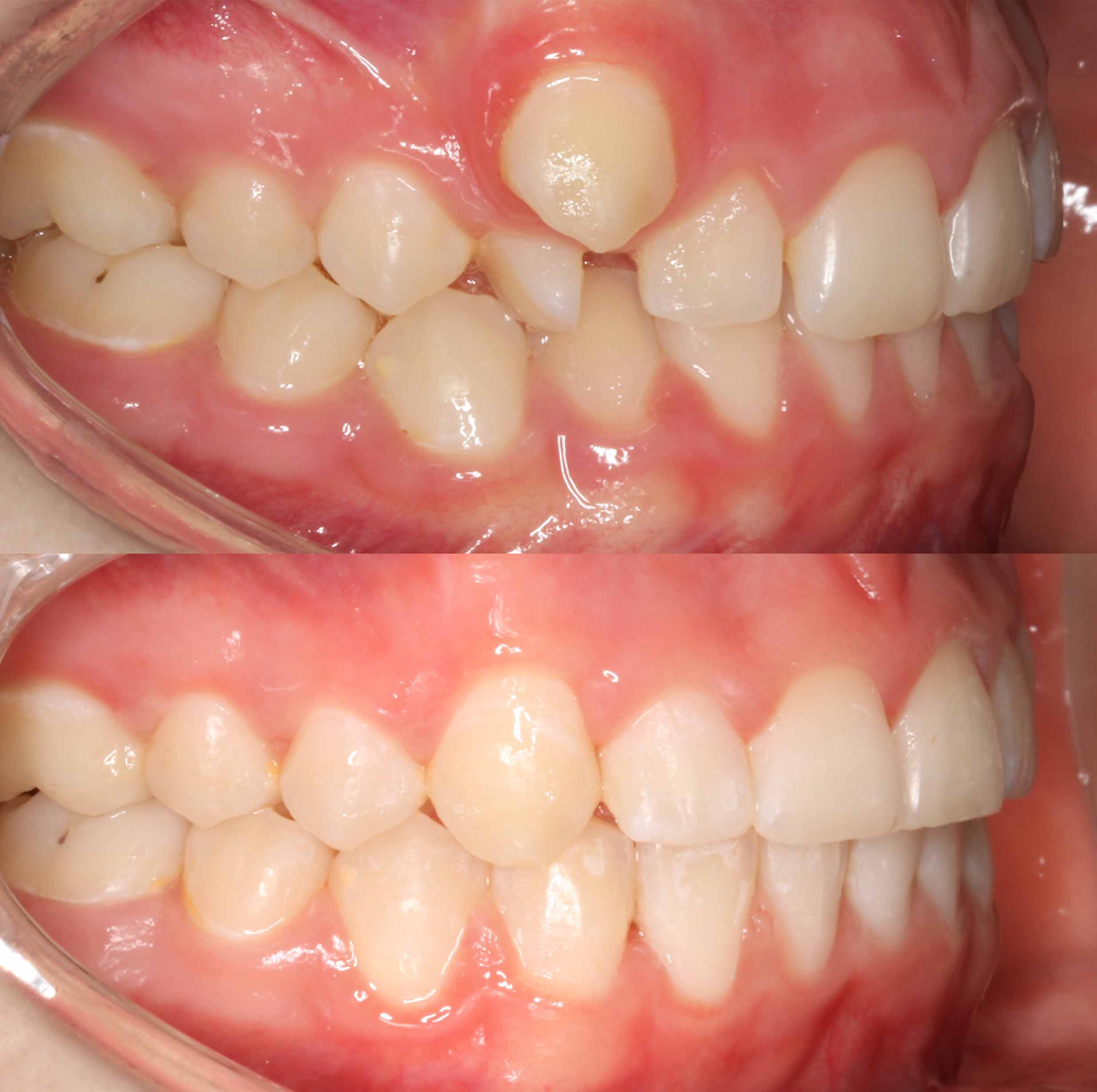 before and after photo of traditional metal fixed braces treatment for adults