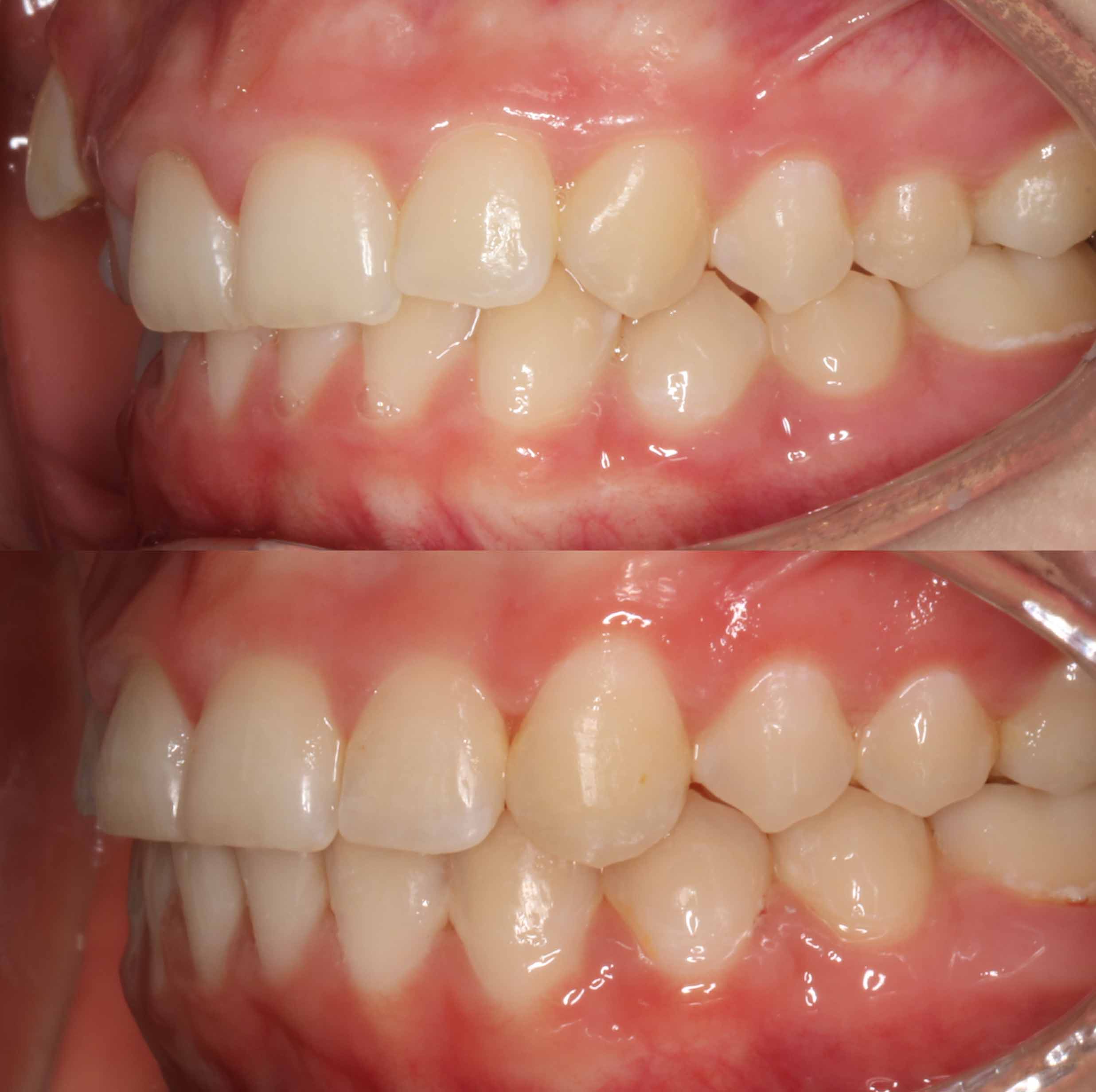 before and after photo of traditional metal fixed braces treatment for adults