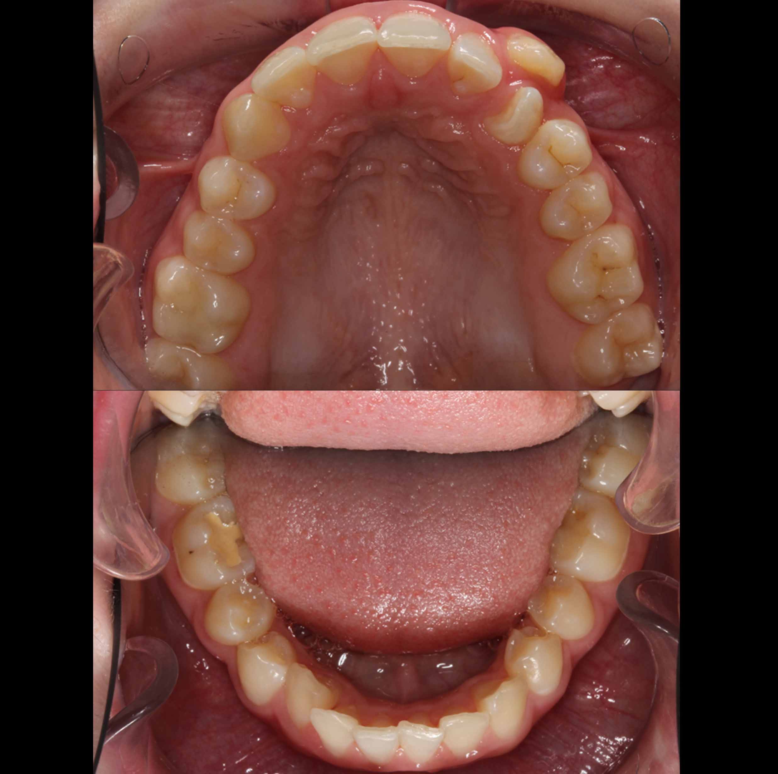before and after photo of traditional metal fixed braces treatment for adults