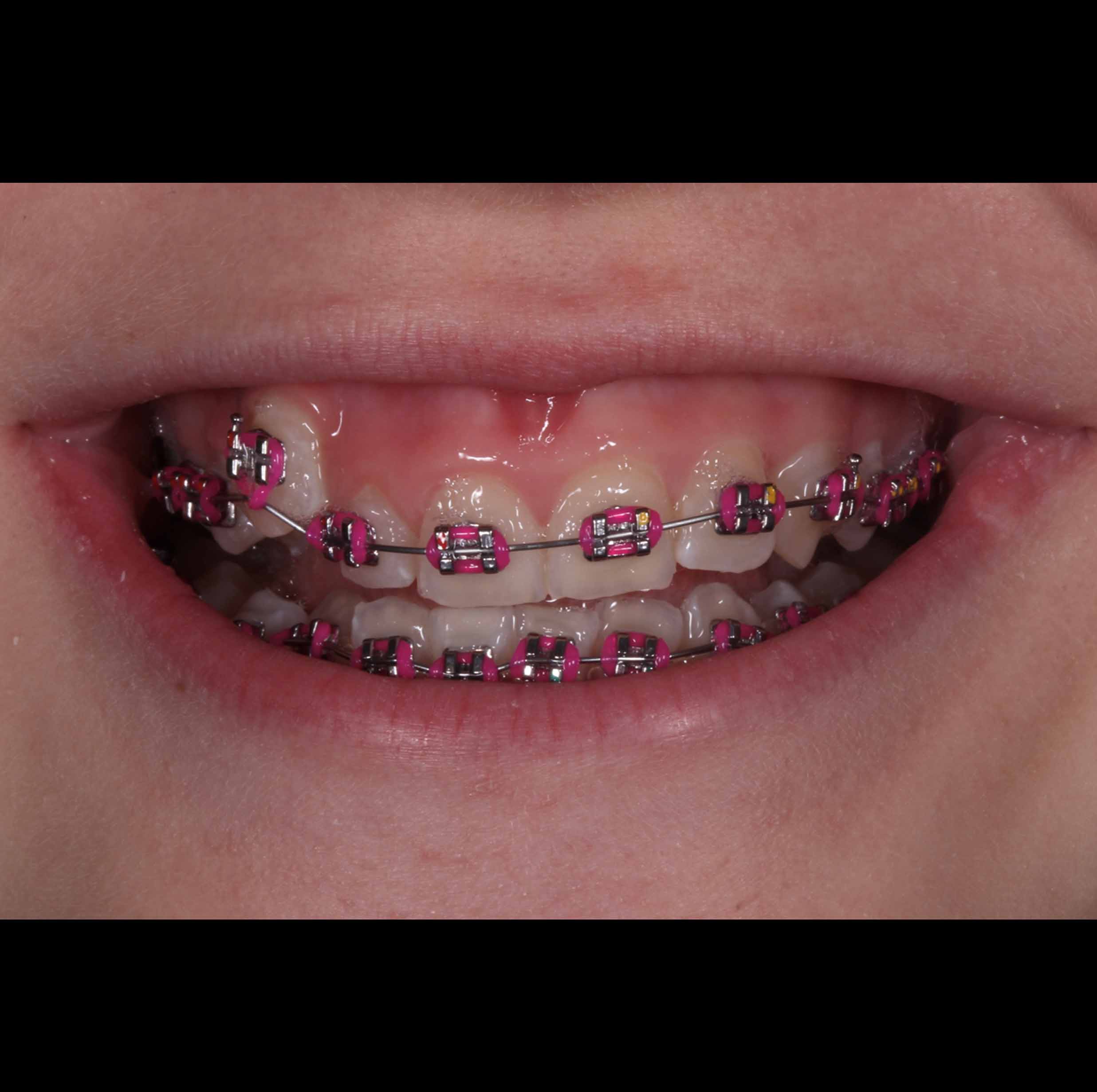 before and after photo of traditional metal fixed braces treatment for adults