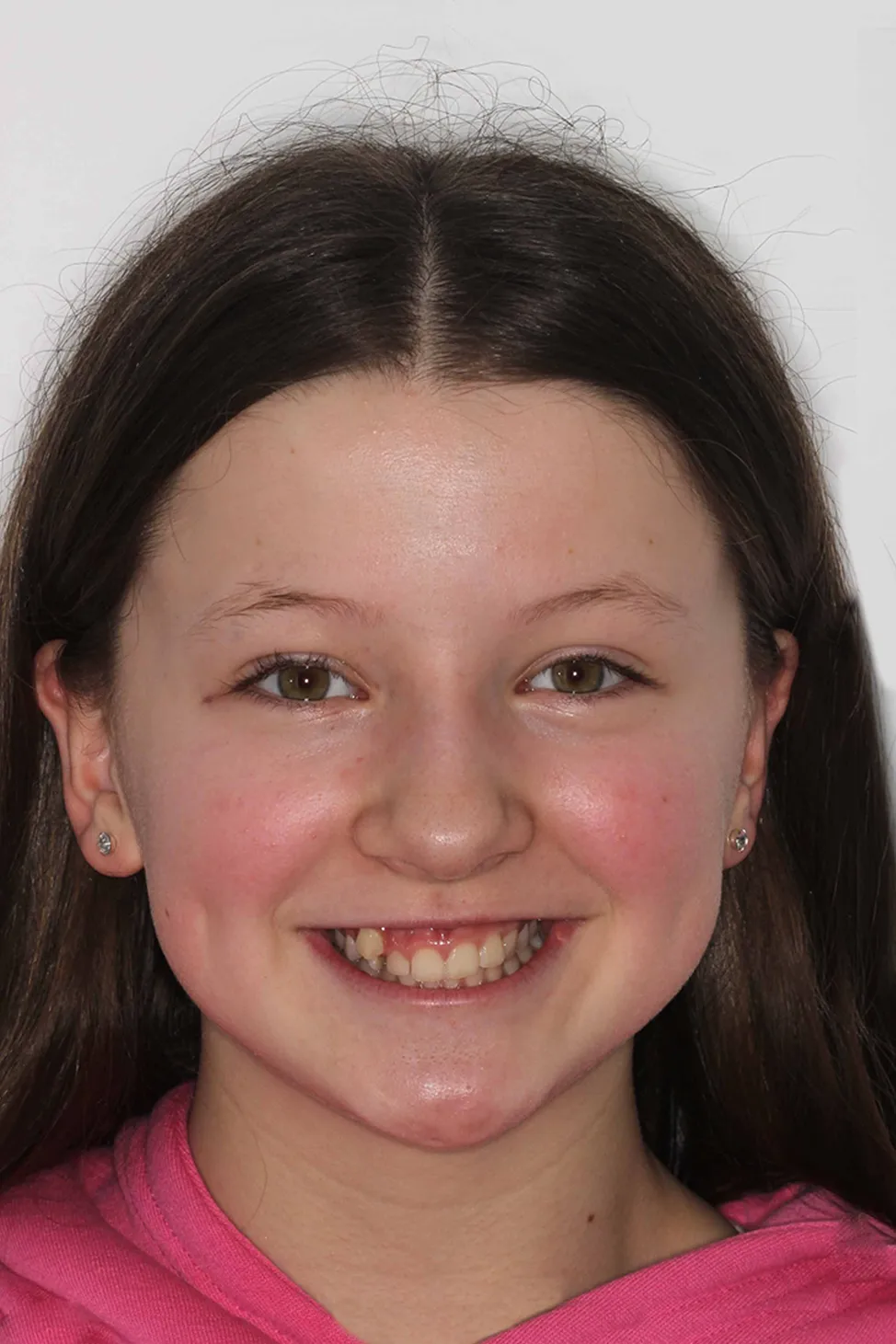 before and after photo of traditional metal fixed braces treatment for adults