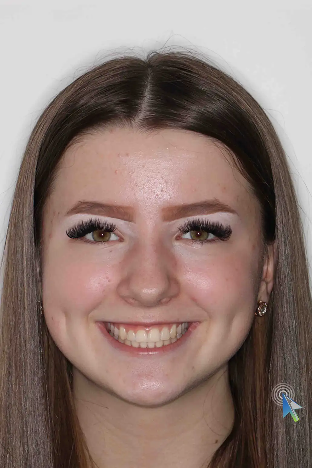 before and after photo of traditional metal fixed braces treatment for adults