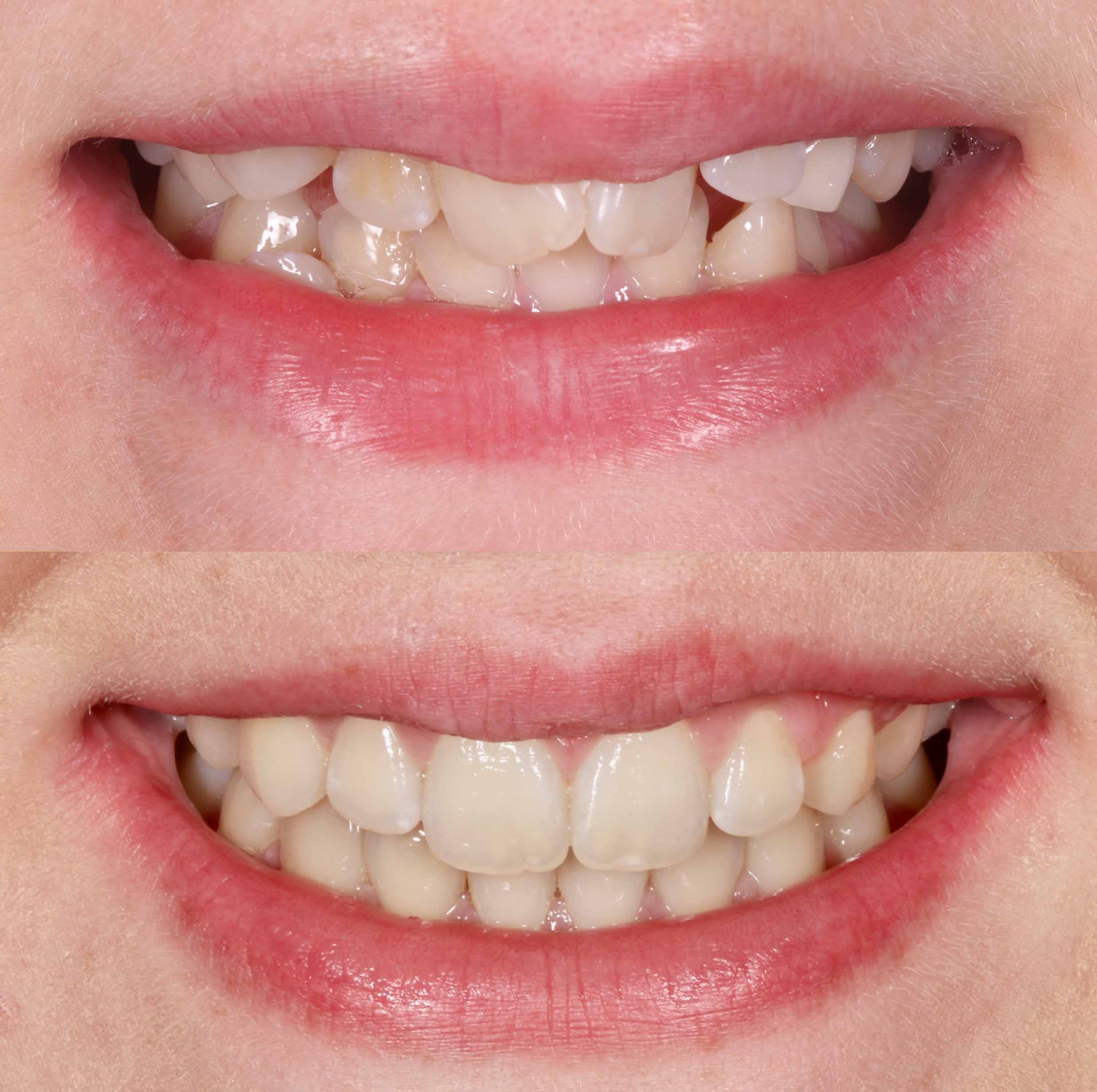 before and after photo of clear ceramic fixed braces treatment for adults
