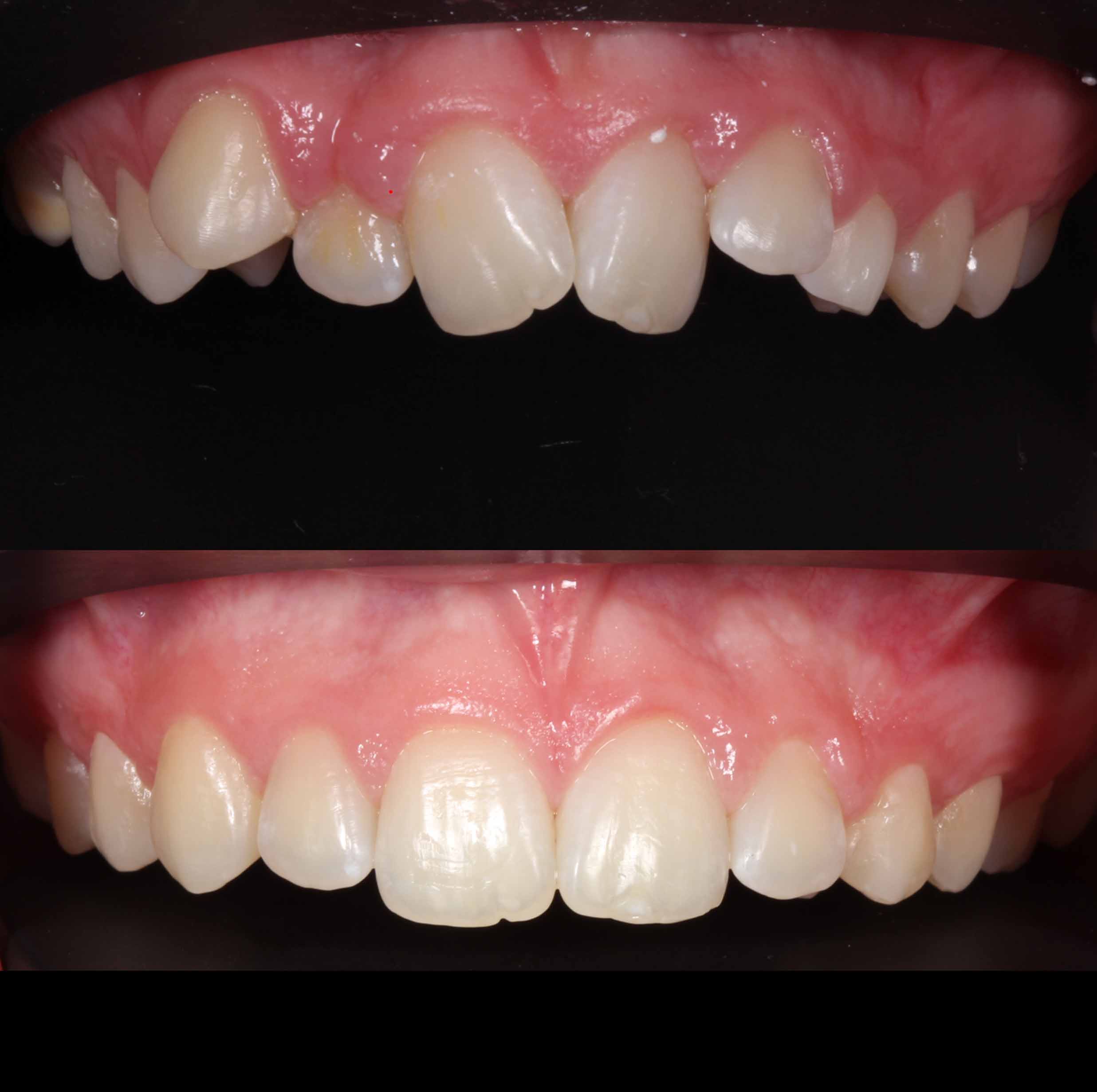 before and after photo of clear ceramic fixed braces treatment for adults
