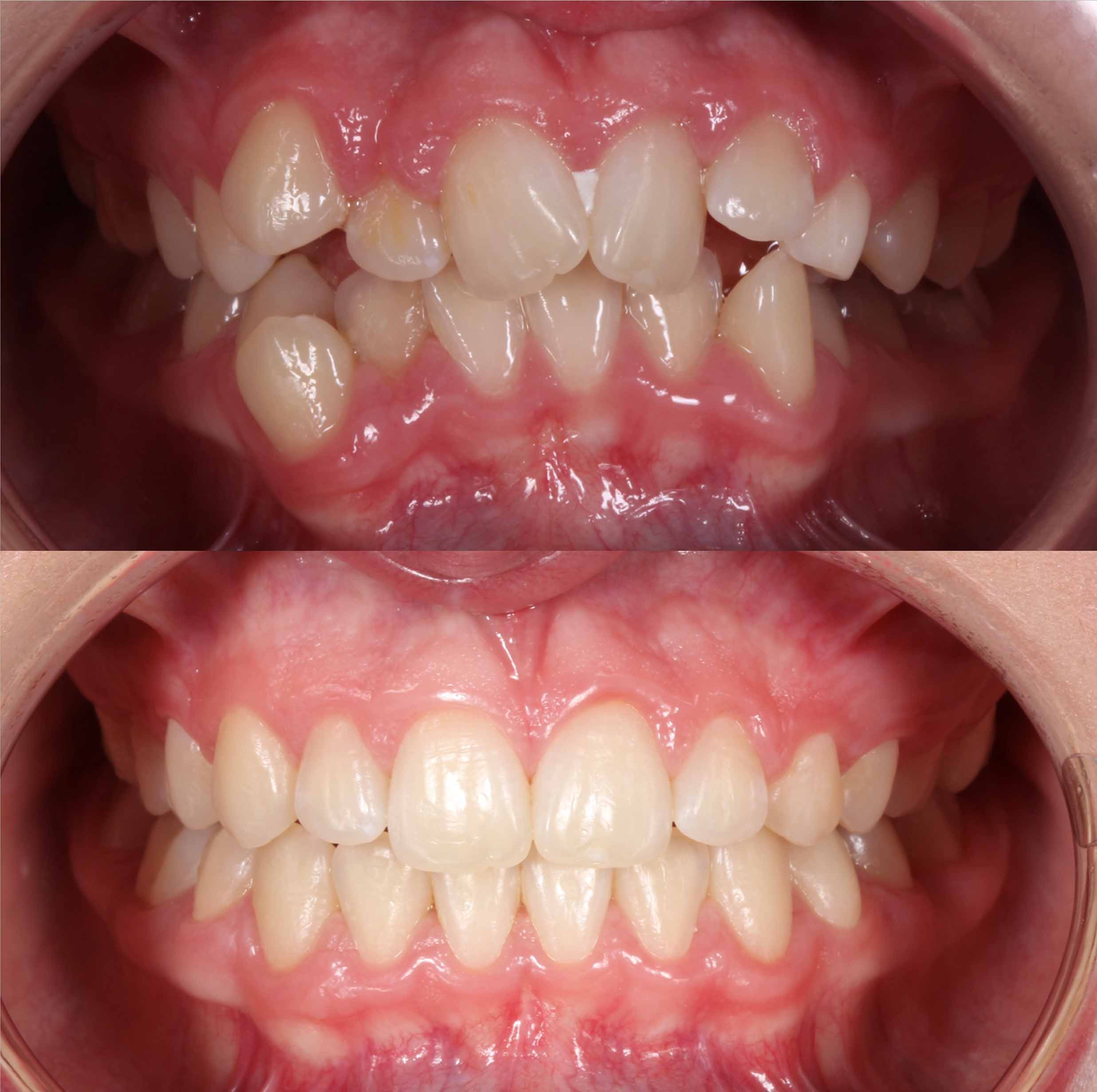 before and after photo of clear ceramic fixed braces treatment for adults
