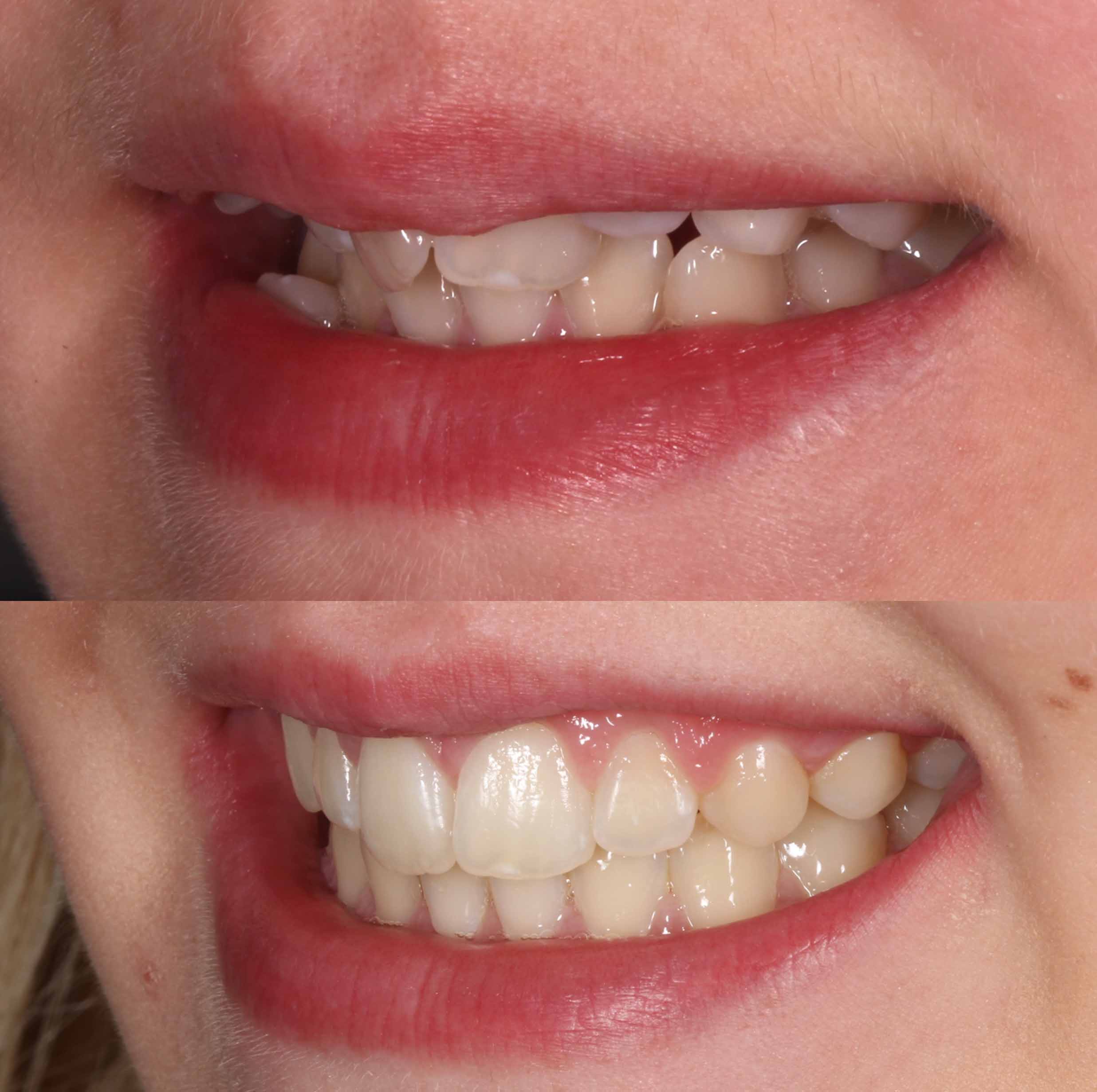 before and after photo of clear ceramic fixed braces treatment for adults
