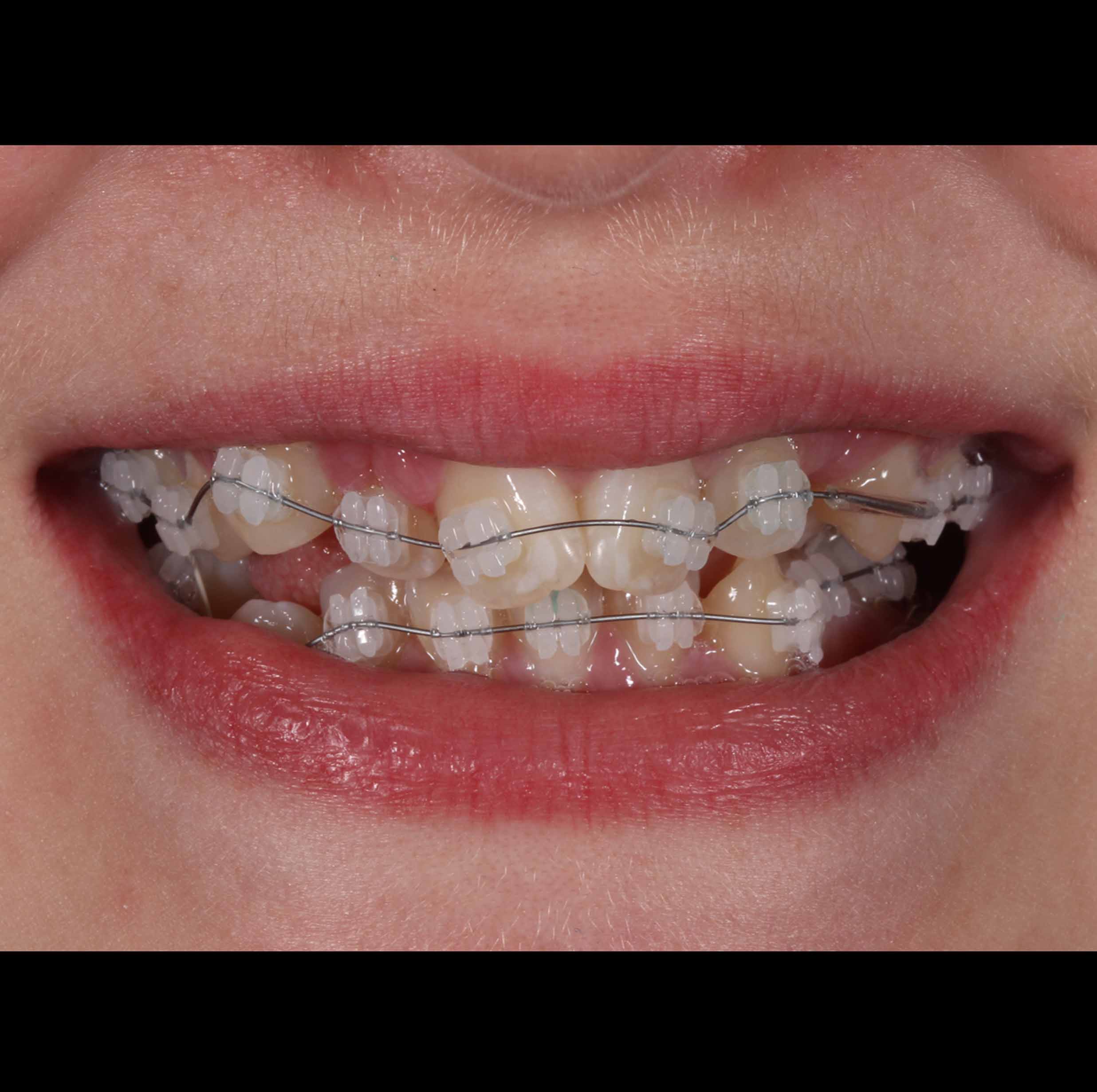 before and after photo of clear ceramic fixed braces treatment for adults
