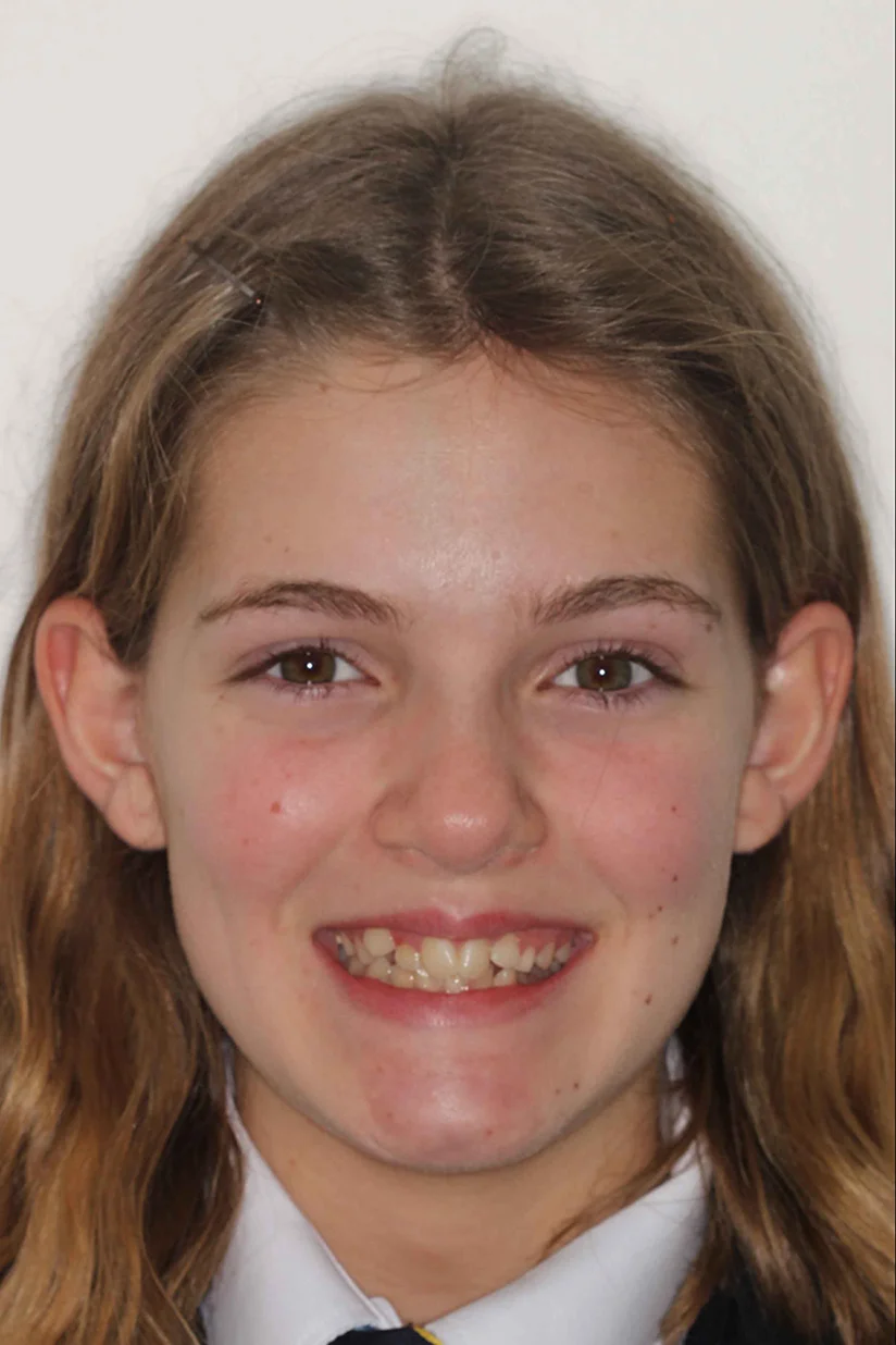 before and after photo of clear ceramic fixed braces treatment for adults
