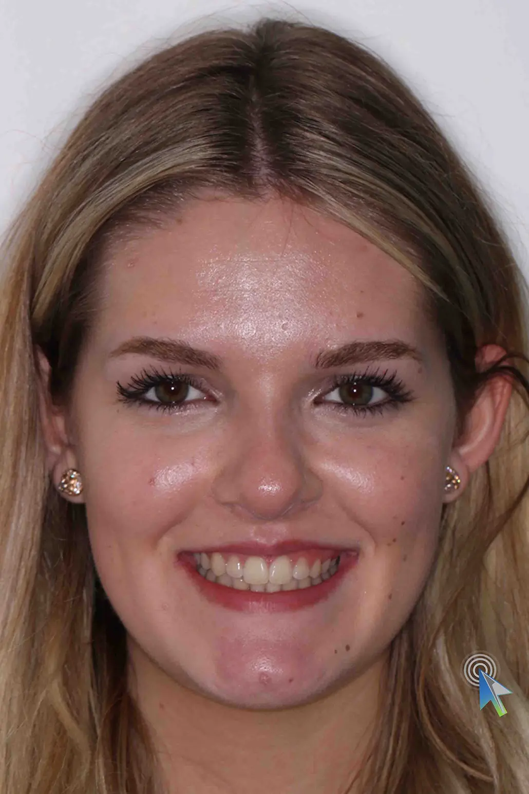 before and after photo of clear ceramic fixed braces treatment for adults
