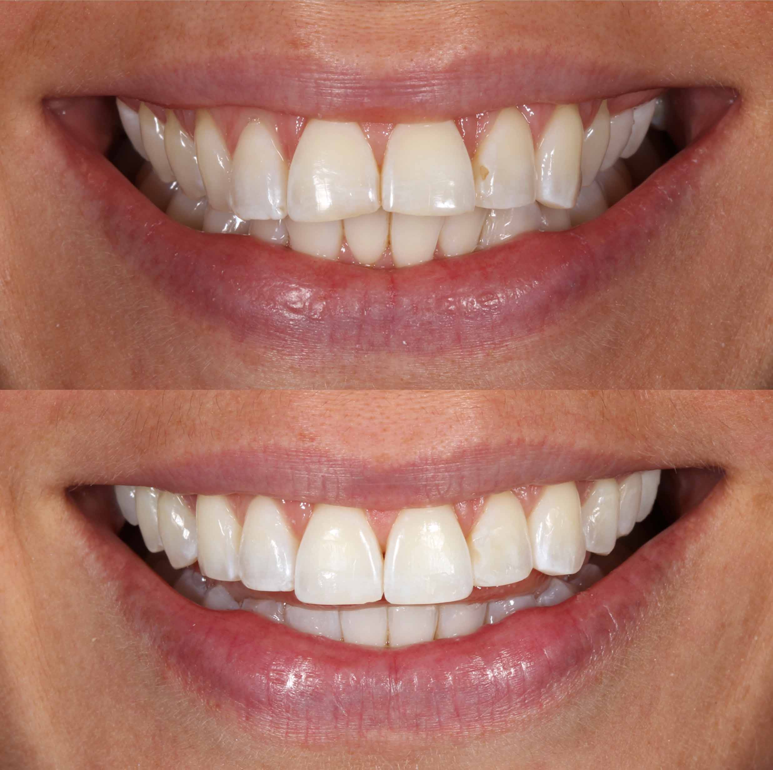 before and after photo of Invisalign and teeth whitening treatment for adults