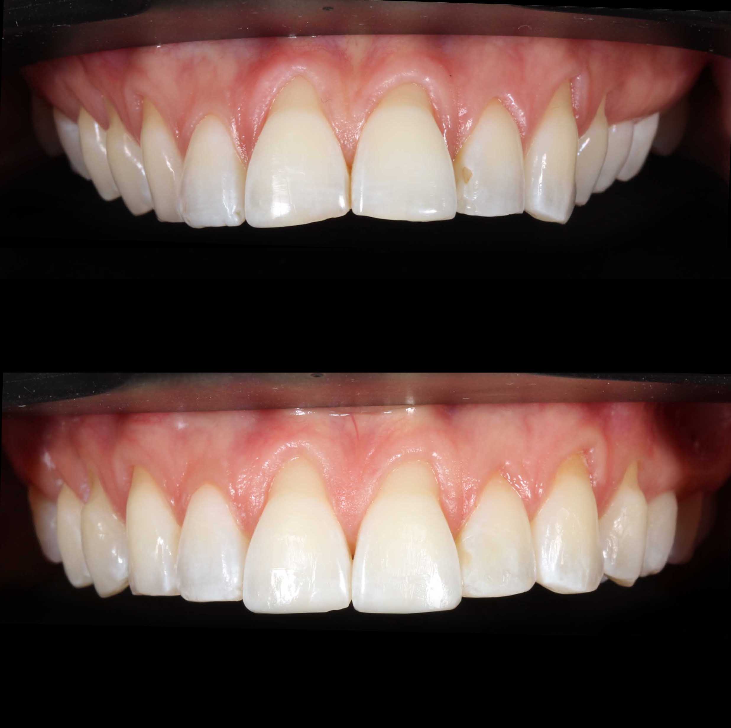 before and after photo of Invisalign and teeth whitening treatment for adults