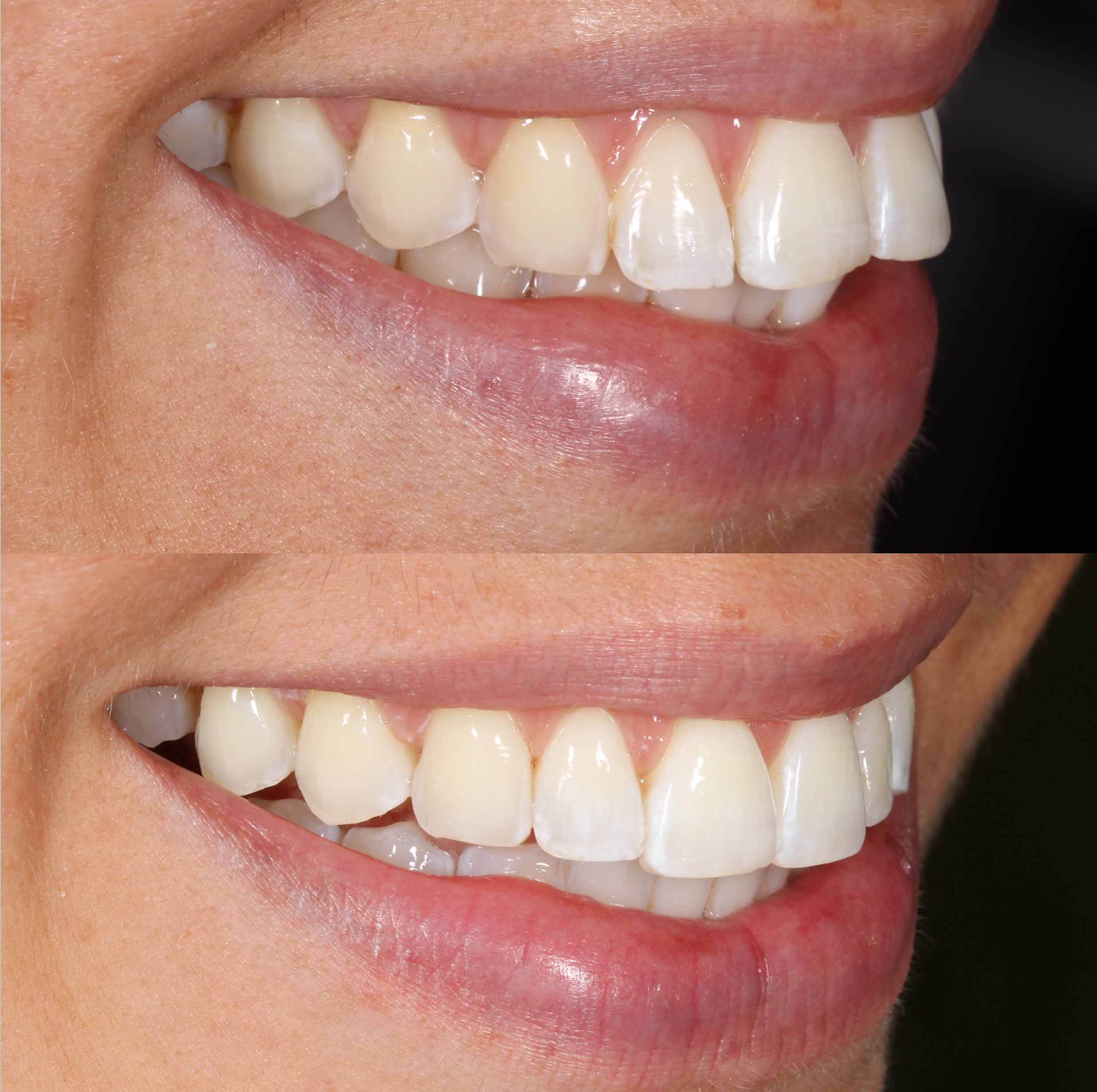 before and after photo of Invisalign and teeth whitening treatment for adults