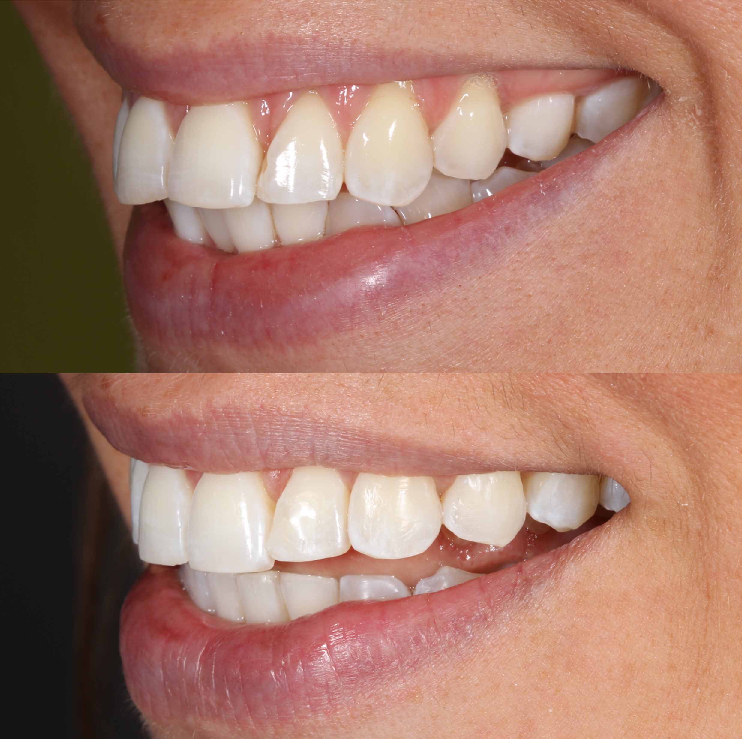 before and after photo of Invisalign and teeth whitening treatment for adults