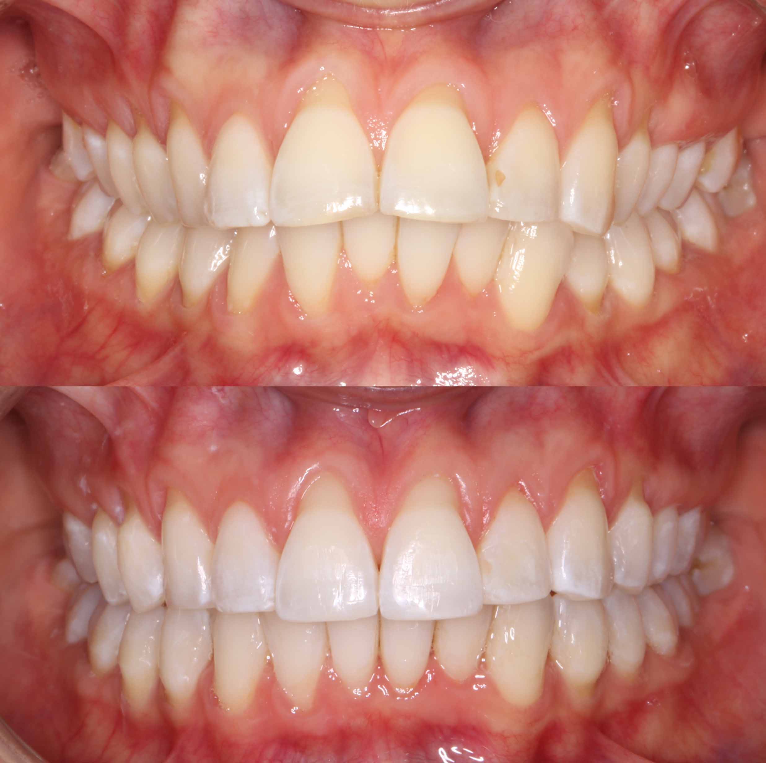 before and after photo of Invisalign and teeth whitening treatment for adults