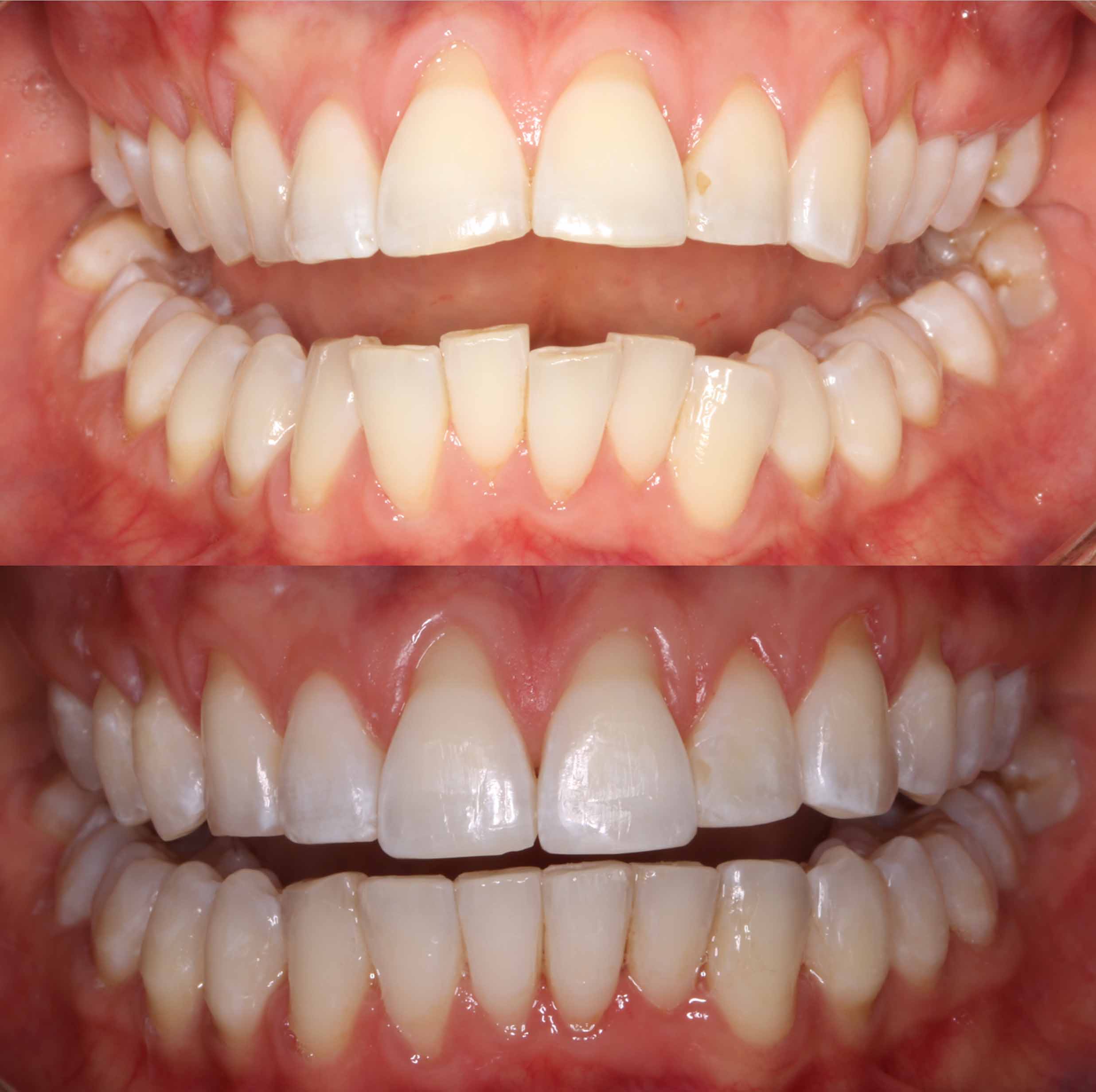 before and after photo of Invisalign and teeth whitening treatment for adults