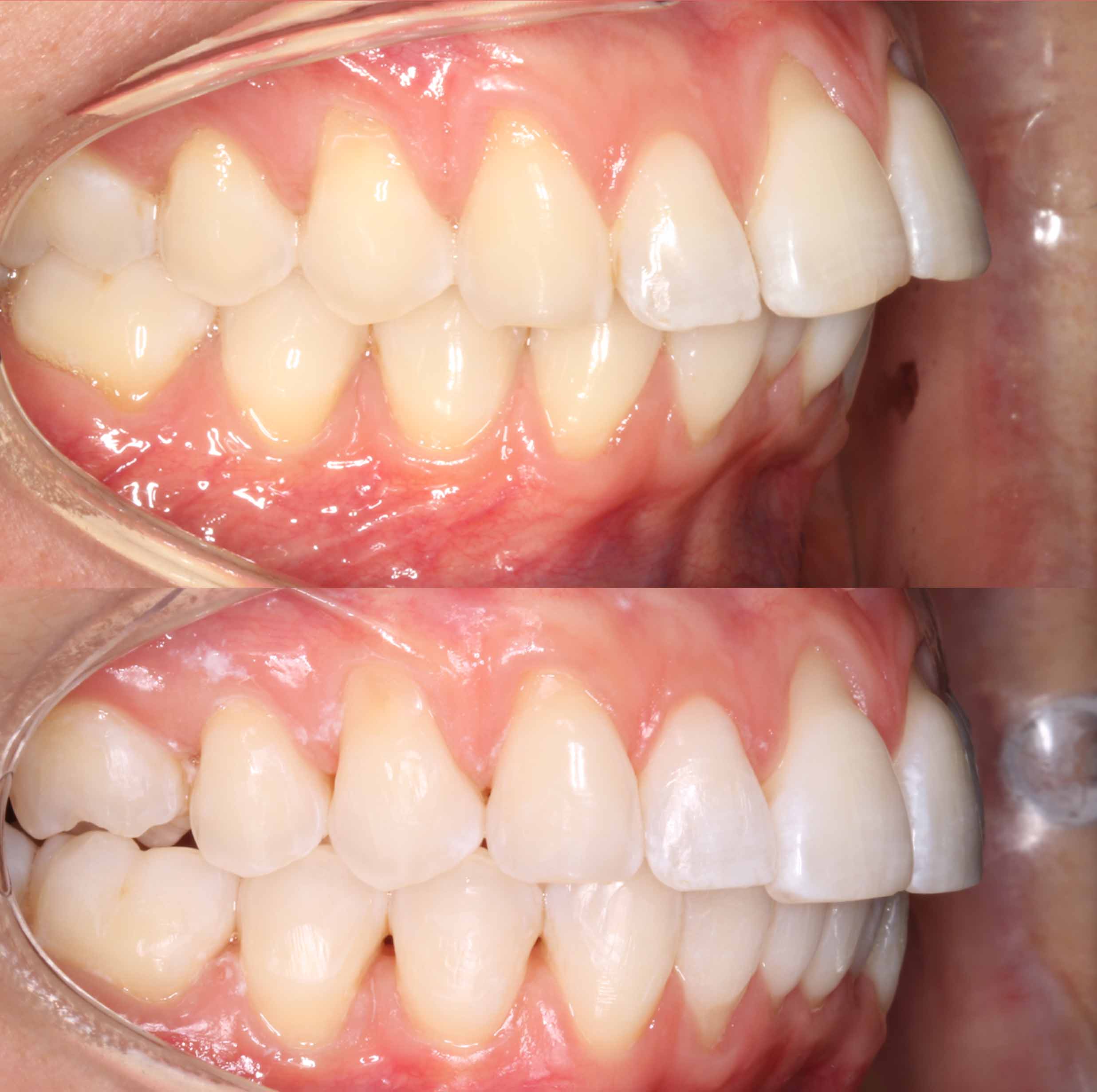 before and after photo of Invisalign and teeth whitening treatment for adults