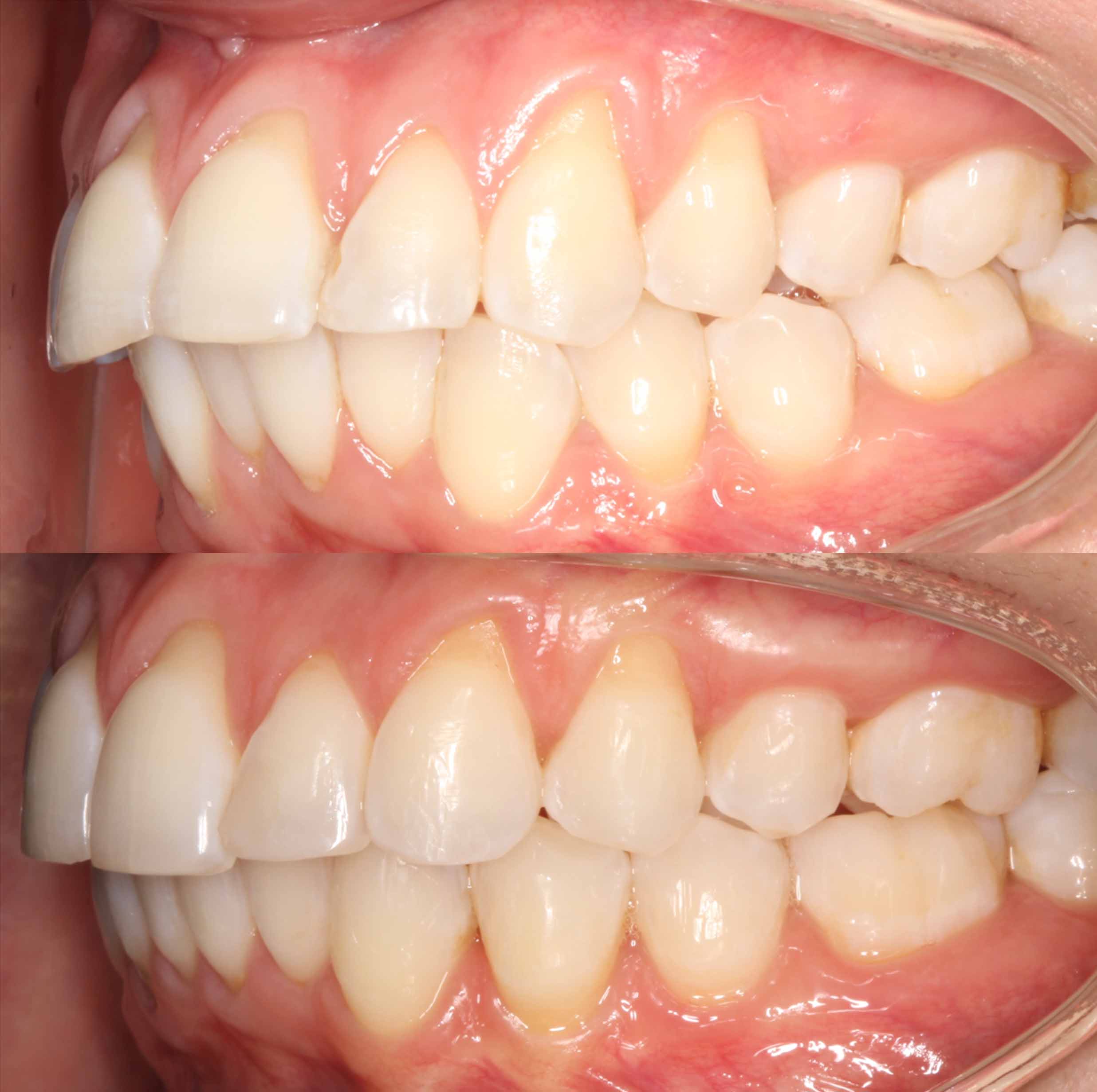 before and after photo of Invisalign and teeth whitening treatment for adults